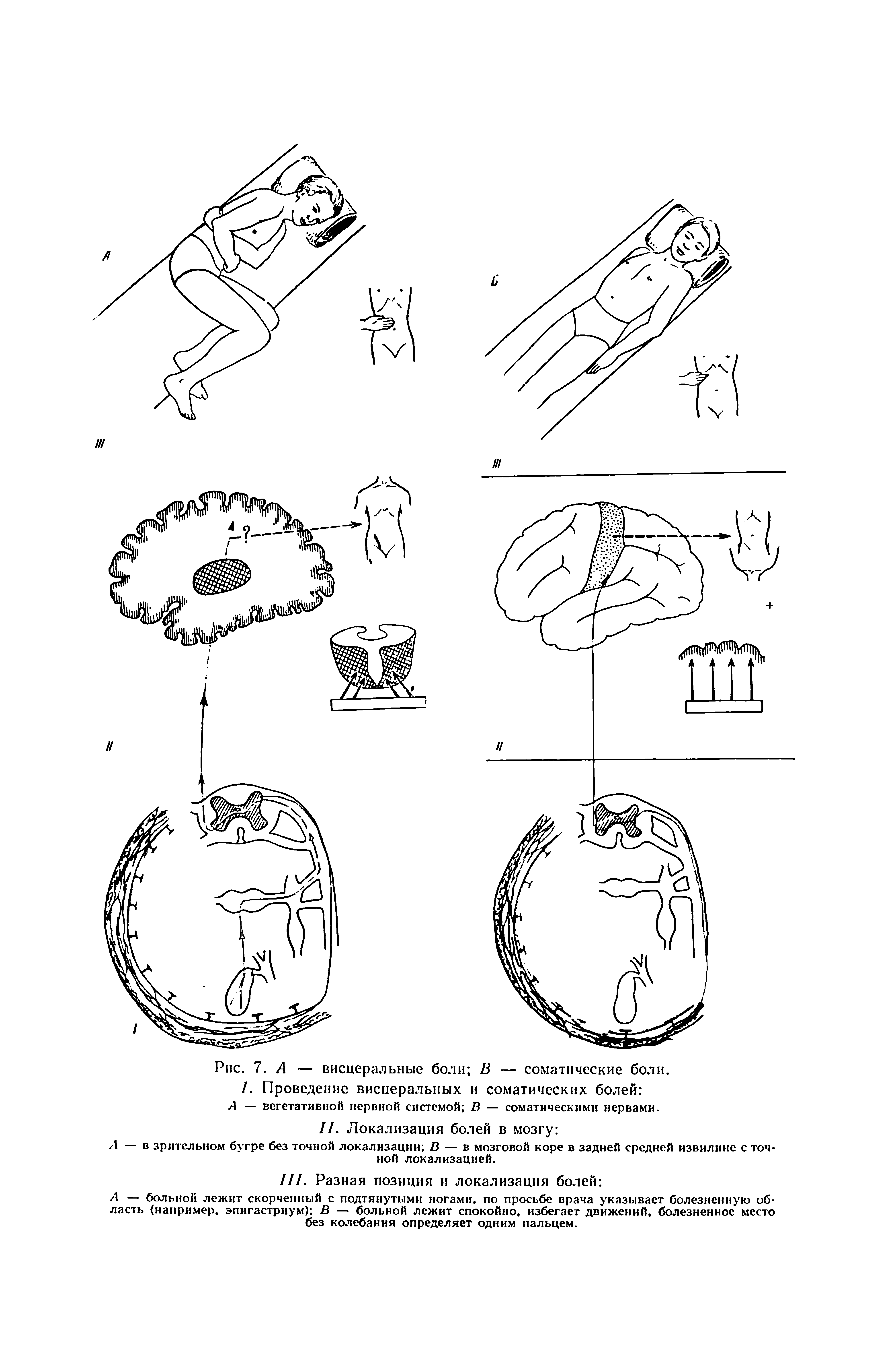 Рис. 7. А — висцеральные боли В — соматические боли. /. Проведение висцеральных и соматических болей А — вегетативной нервной системой В — соматическими нервами.