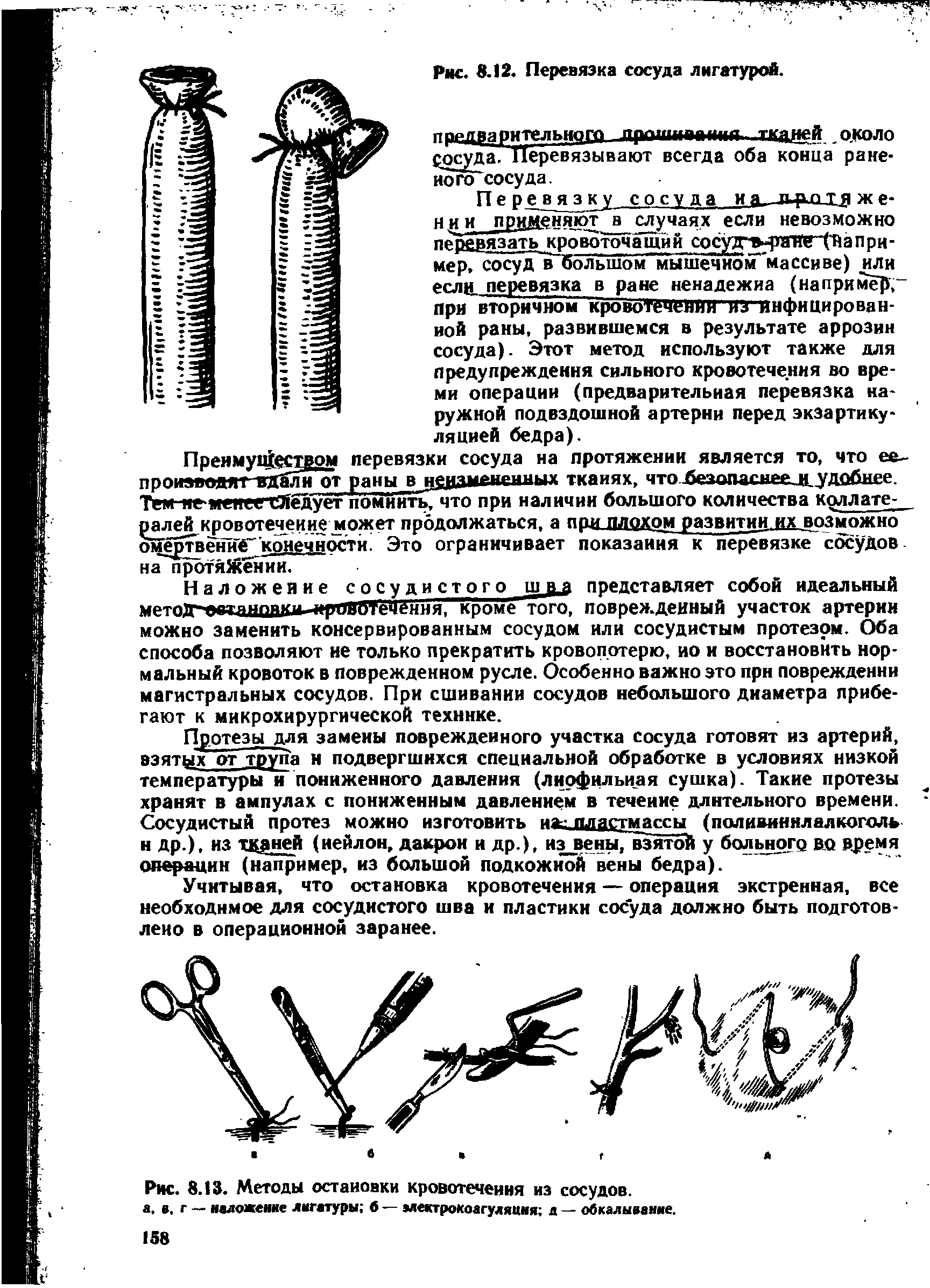 Рис. 8.13. Методы остановки кровотечения из сосудов, а. в, г — наложение лигатуры б — электрокоагуляция а — обкалывание.