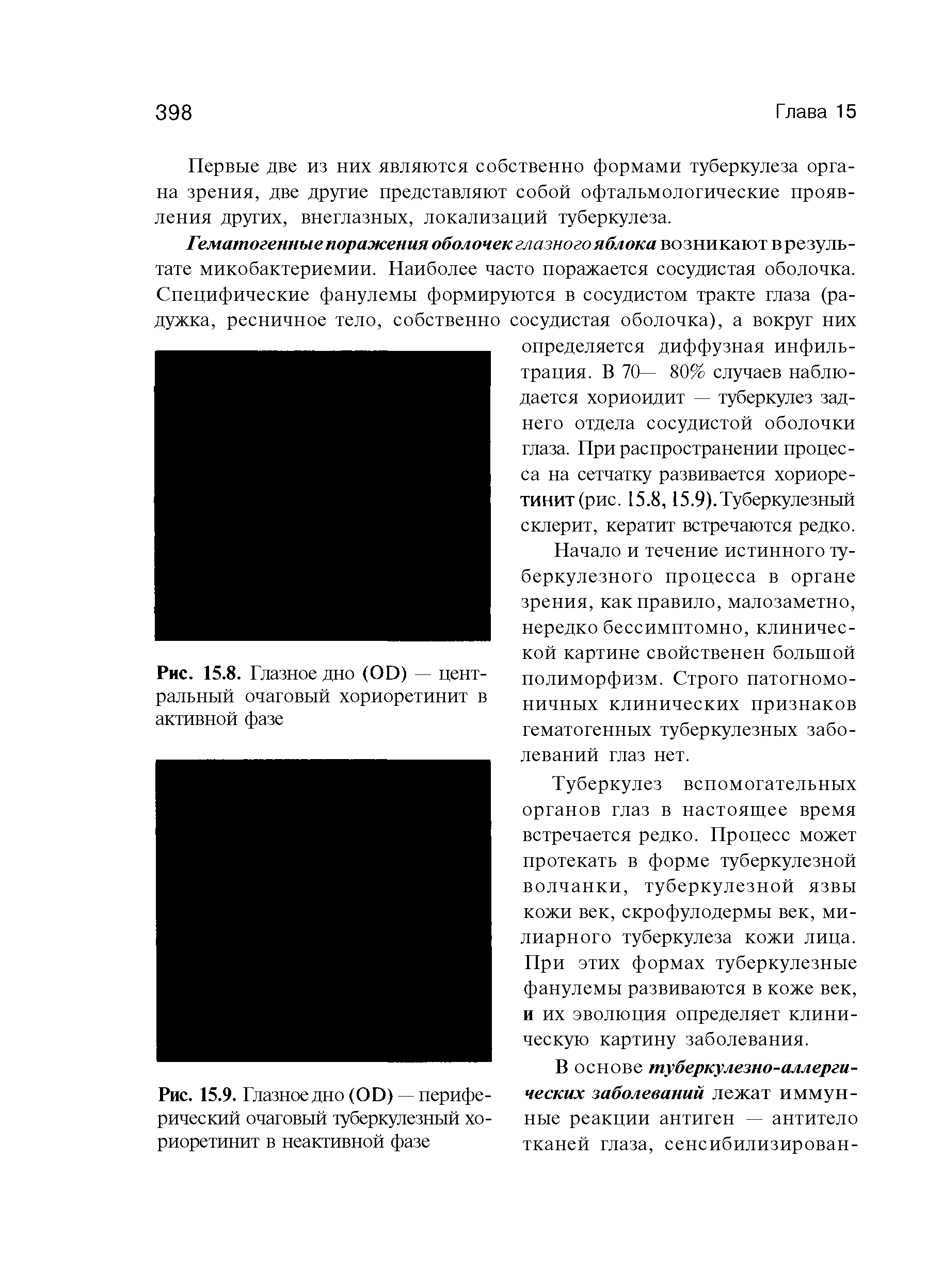 Рис. 15.8. Глазное дно (ОО) — центральный очаговый хориоретинит в активной фазе...