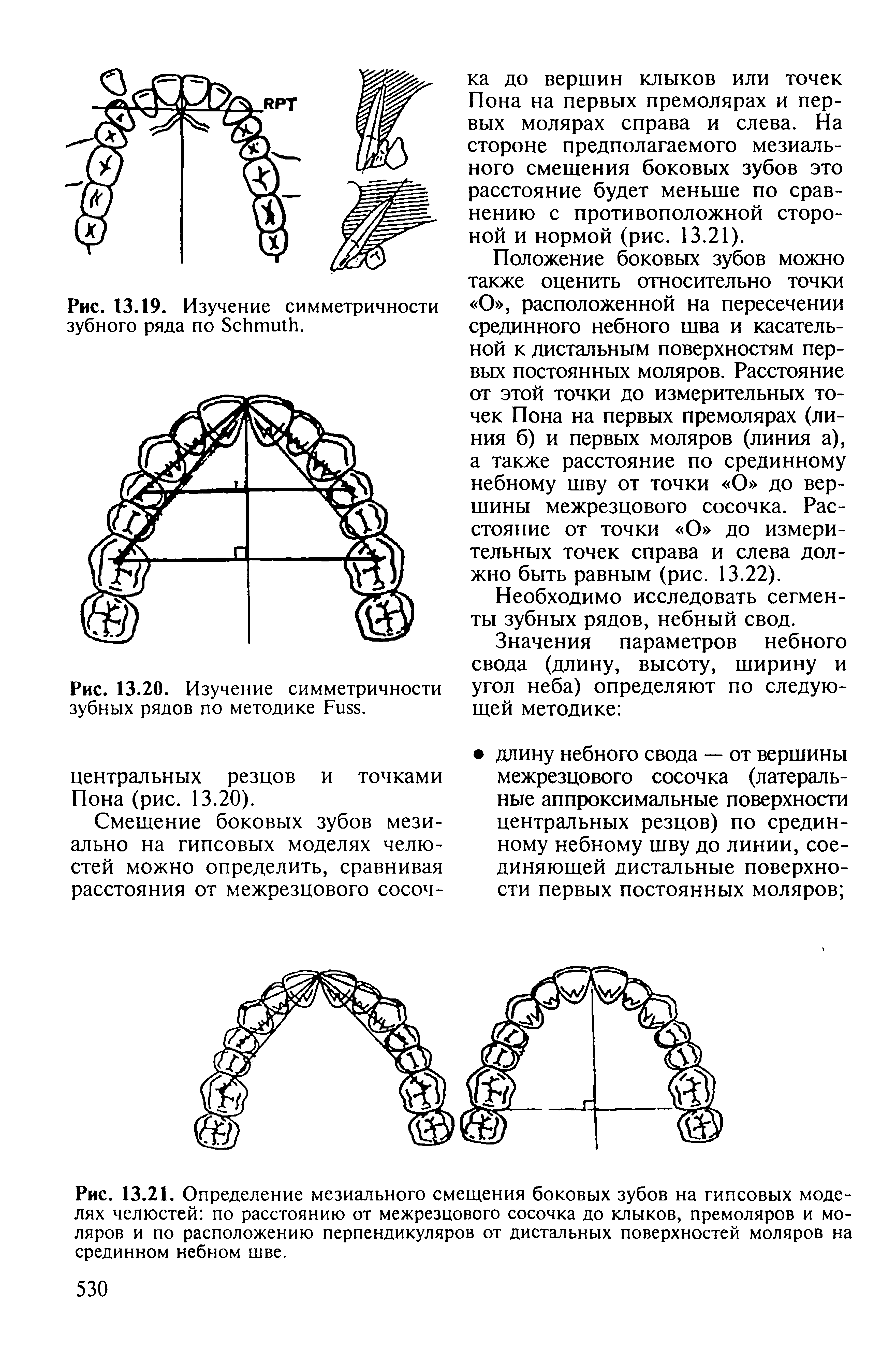 Рис. 13.21. Определение мезиального смещения боковых зубов на гипсовых моделях челюстей по расстоянию от межрезцового сосочка до клыков, премоляров и моляров и по расположению перпендикуляров от дистальных поверхностей моляров на срединном небном шве.