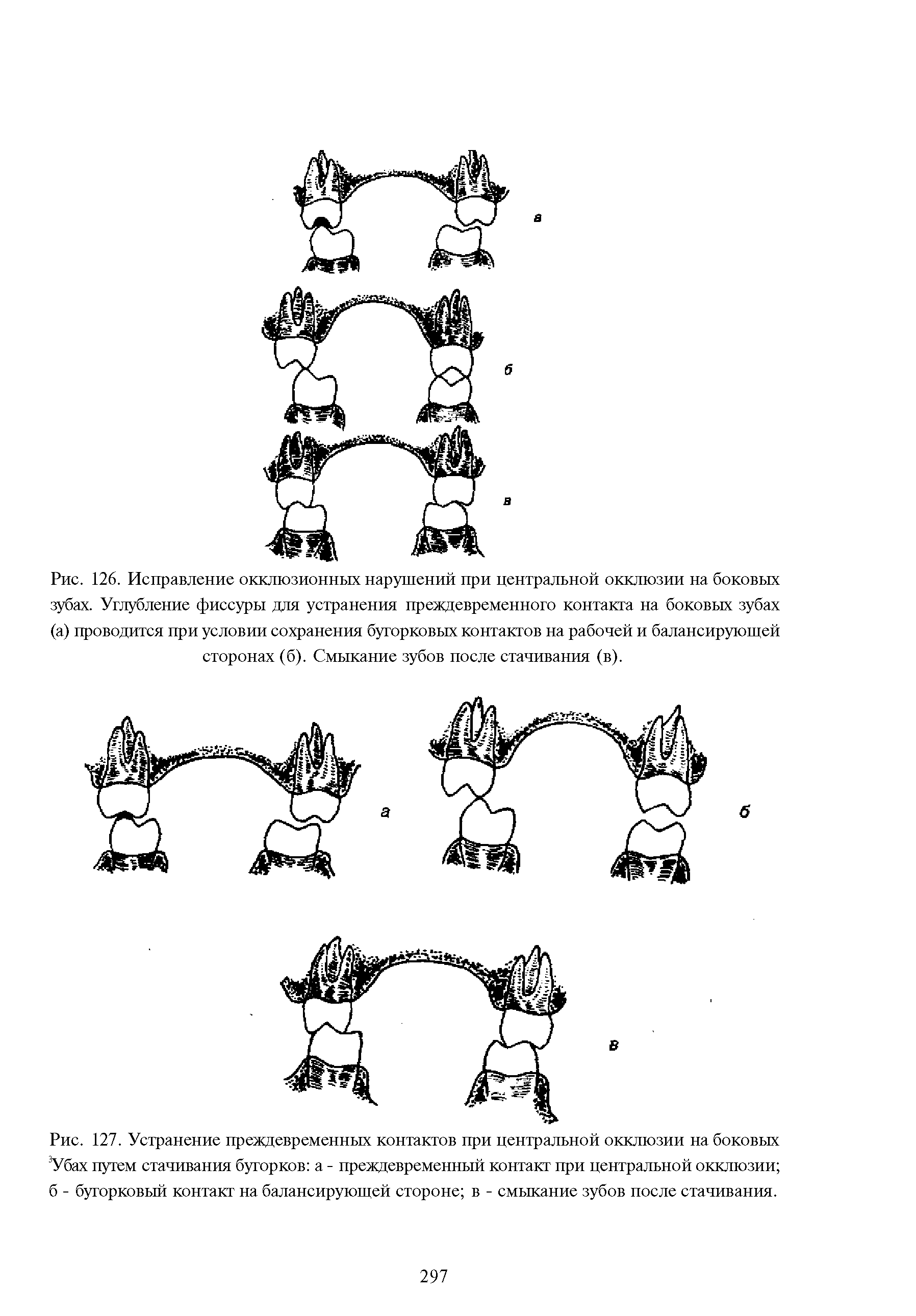 Рис. 127. Устранение преждевременных контактов при центральной окклюзии на боковых Убах путем стачивания бугорков а - преждевременный контакт при центральной окклюзии б - бугорковый контакт на балансирующей стороне в - смыкание зубов после стачивания.
