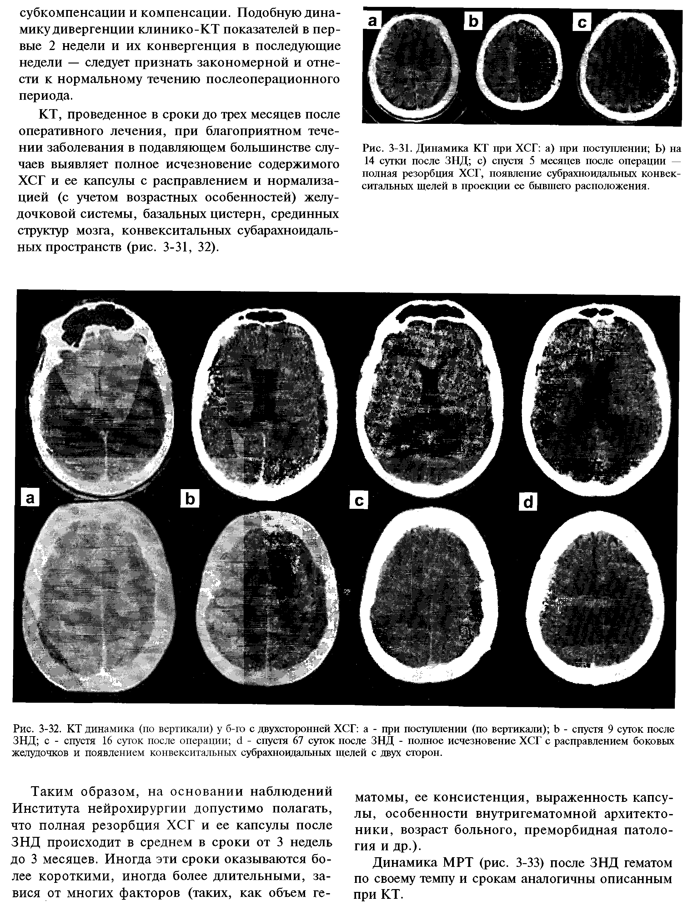 Рис. 3-32. КТ динамика (по вертикали) у б-го с двухсторонней ХСГ а - при поступлении (по вертикали) Ь - спустя 9 суток после ЗНД с - спустя 16 суток после операции <1 - спустя 67 суток после ЗНД - полное исчезновение ХСГ с расправлением боковых желудочков и появлением конвекситальных субрахноидальных щелей с двух сторон.