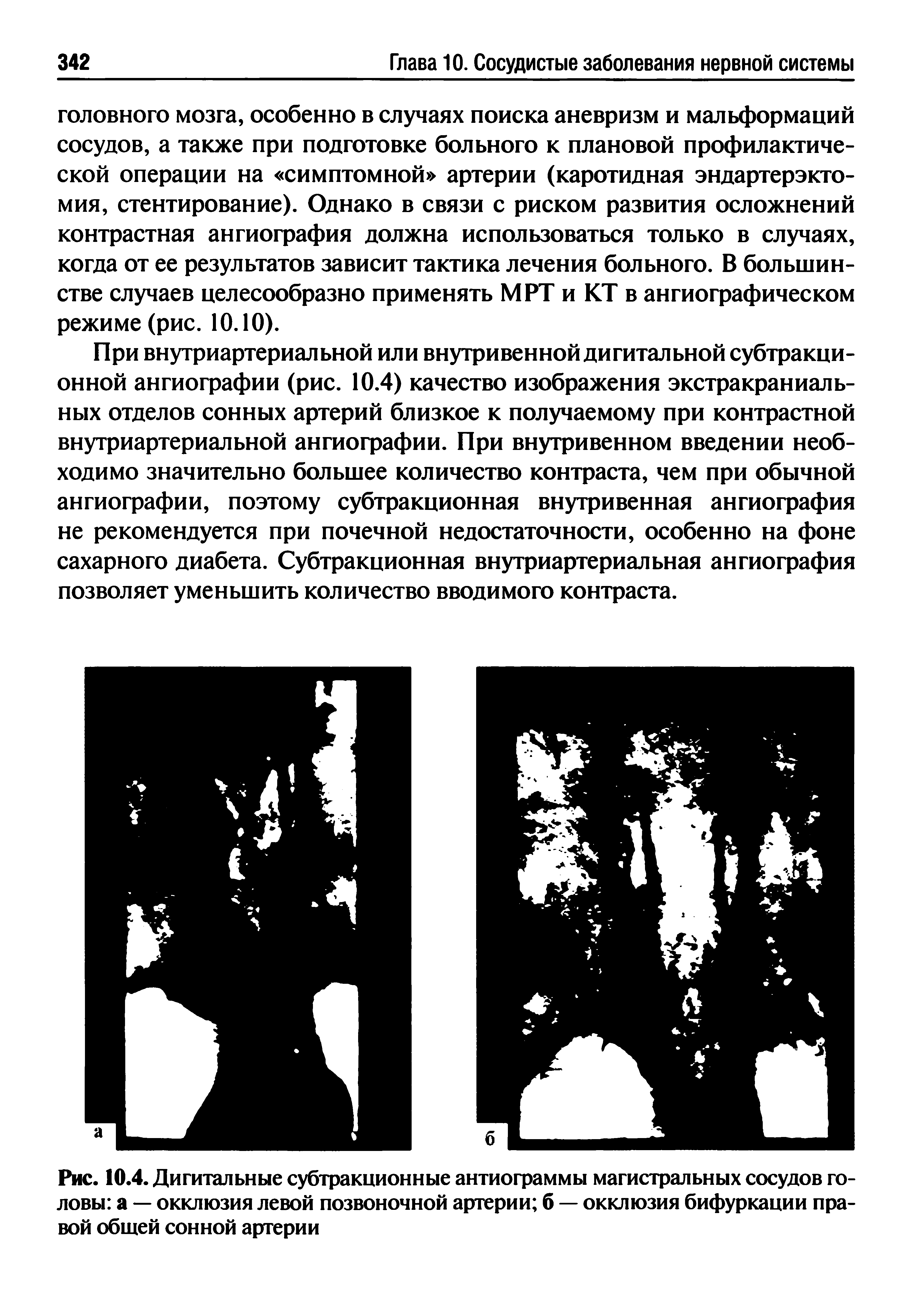 Рис. 10.4. Дигитальные субтракционные ангиограммы магистральных сосудов головы а — окклюзия левой позвоночной артерии б — окклюзия бифуркации правой обшей сонной артерии...