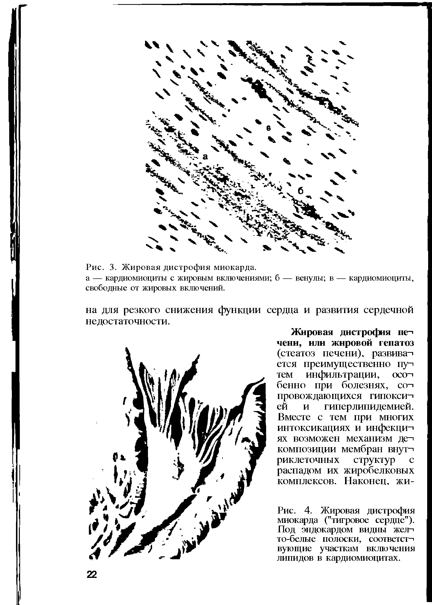 Рис. 4. Жировая дистрофия миокарда ("тигровое сердце"). Под эндокардом видны жел-> то-белые полоски, соответст-1 вующие участкам включения липидов в кардиомиоцитах.