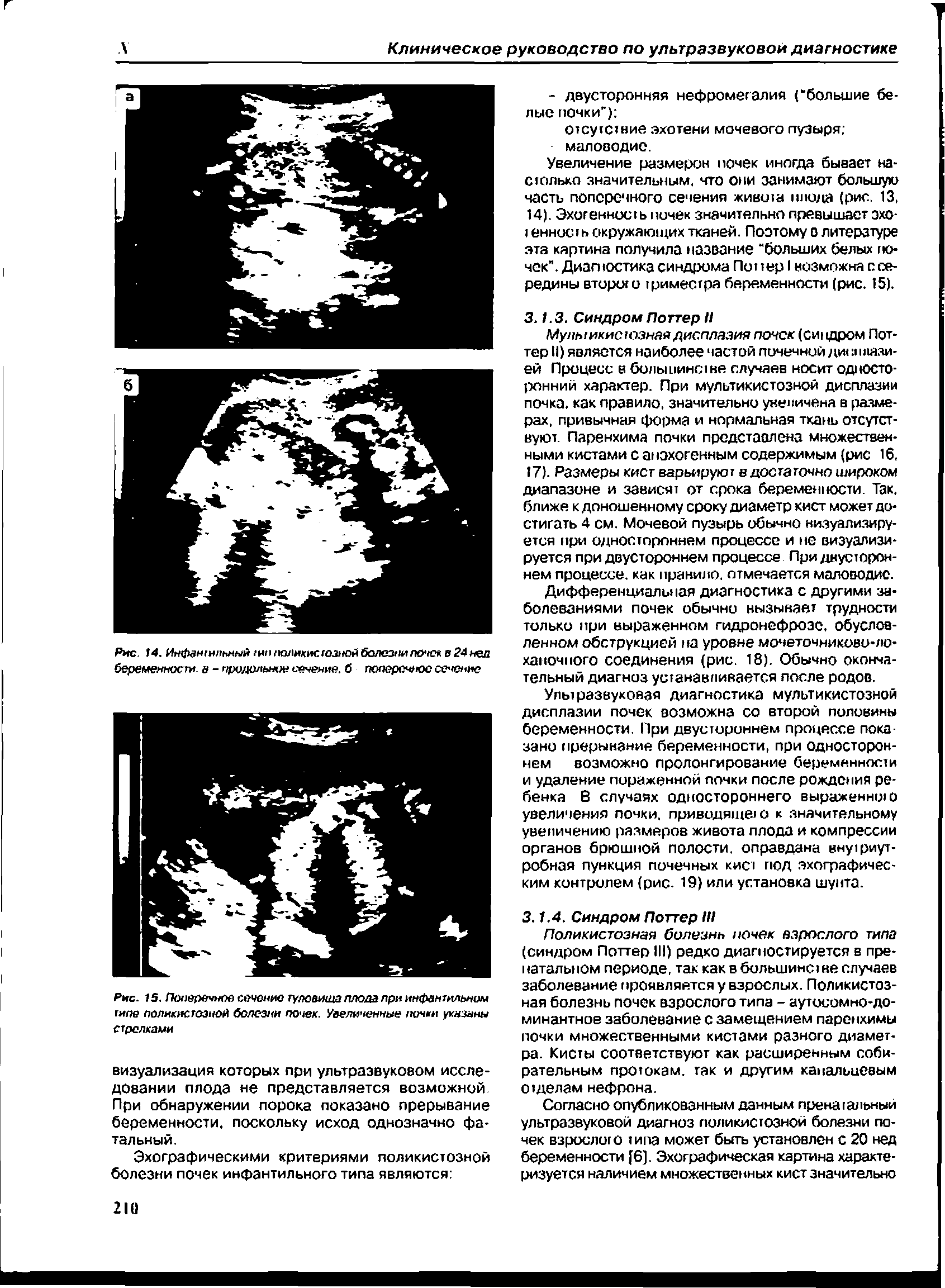 Рис. 15. Поперечное сечение туловища плода при инфантильном типе поликистозной болезни почек. Увеличенные почки указаны стрелками...