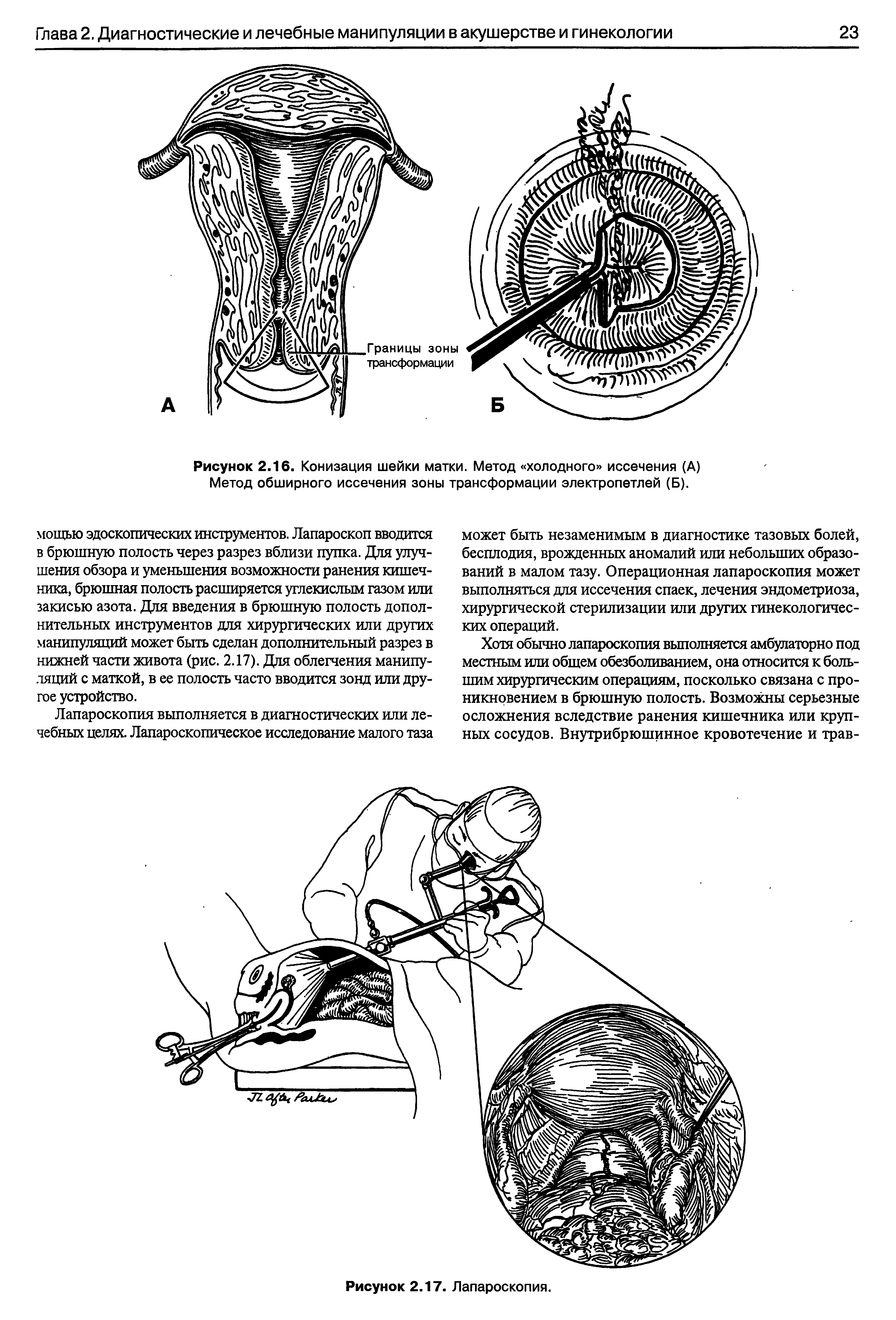 Рисунок 2.16. Конизация шейки матки. Метод холодного иссечения (А) Метод обширного иссечения зоны трансформации электропетлей (Б).