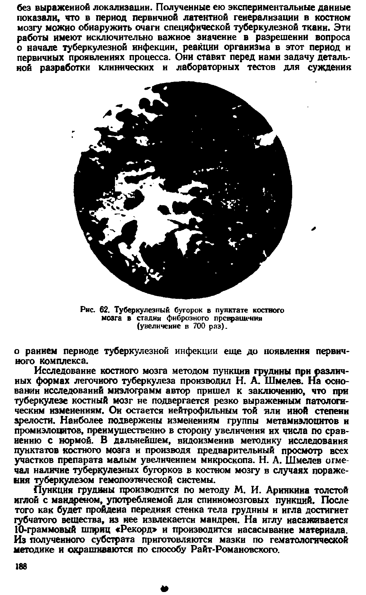 Рис. 62. Туберкулезный бугорок в пулктате костного мозга в стадии фиброзного превращении (увеличение в 700 раз).