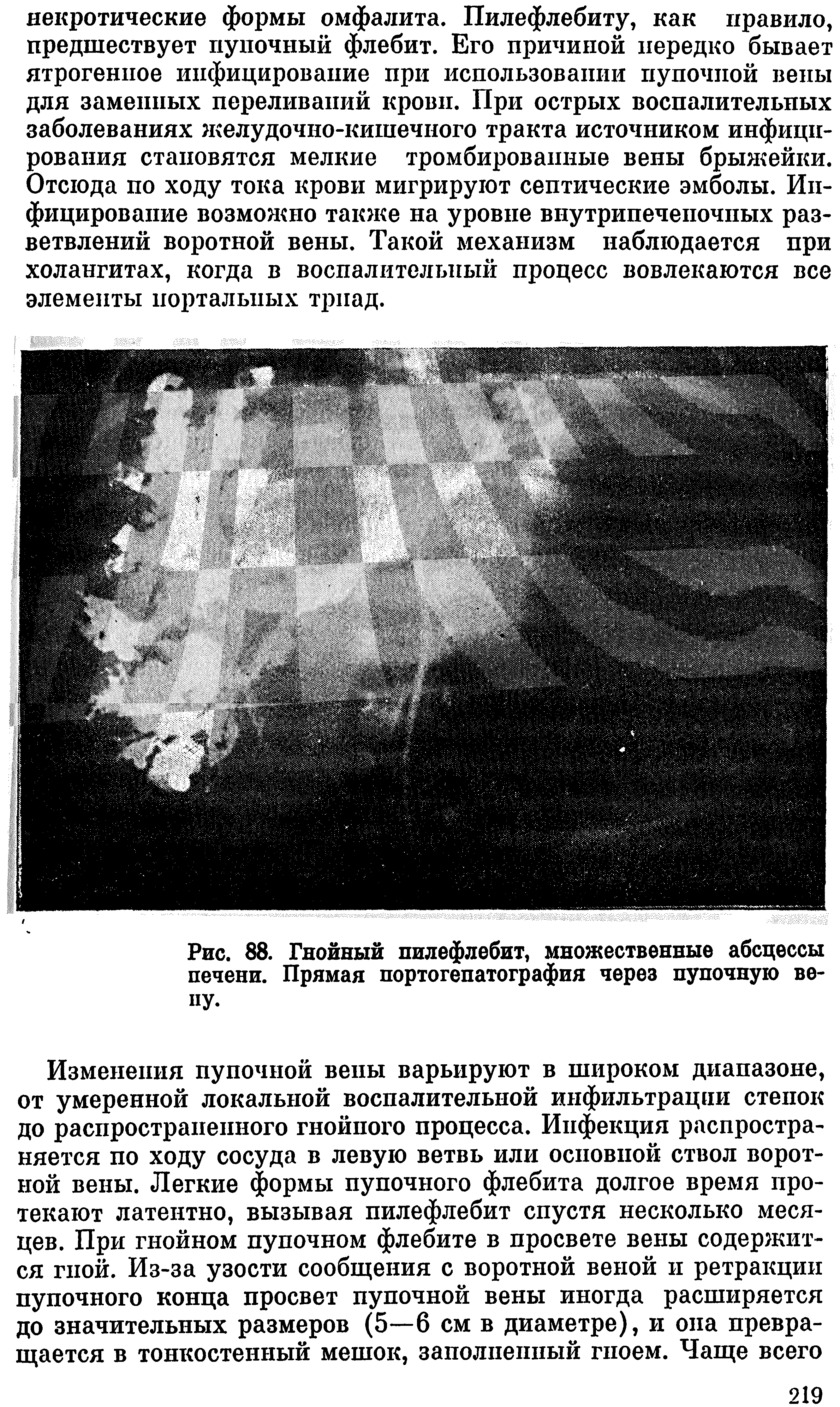 Рис. 88. Гнойный пилефлебит, множественные абсцессы печени. Прямая портогепатография через пупочную вену.