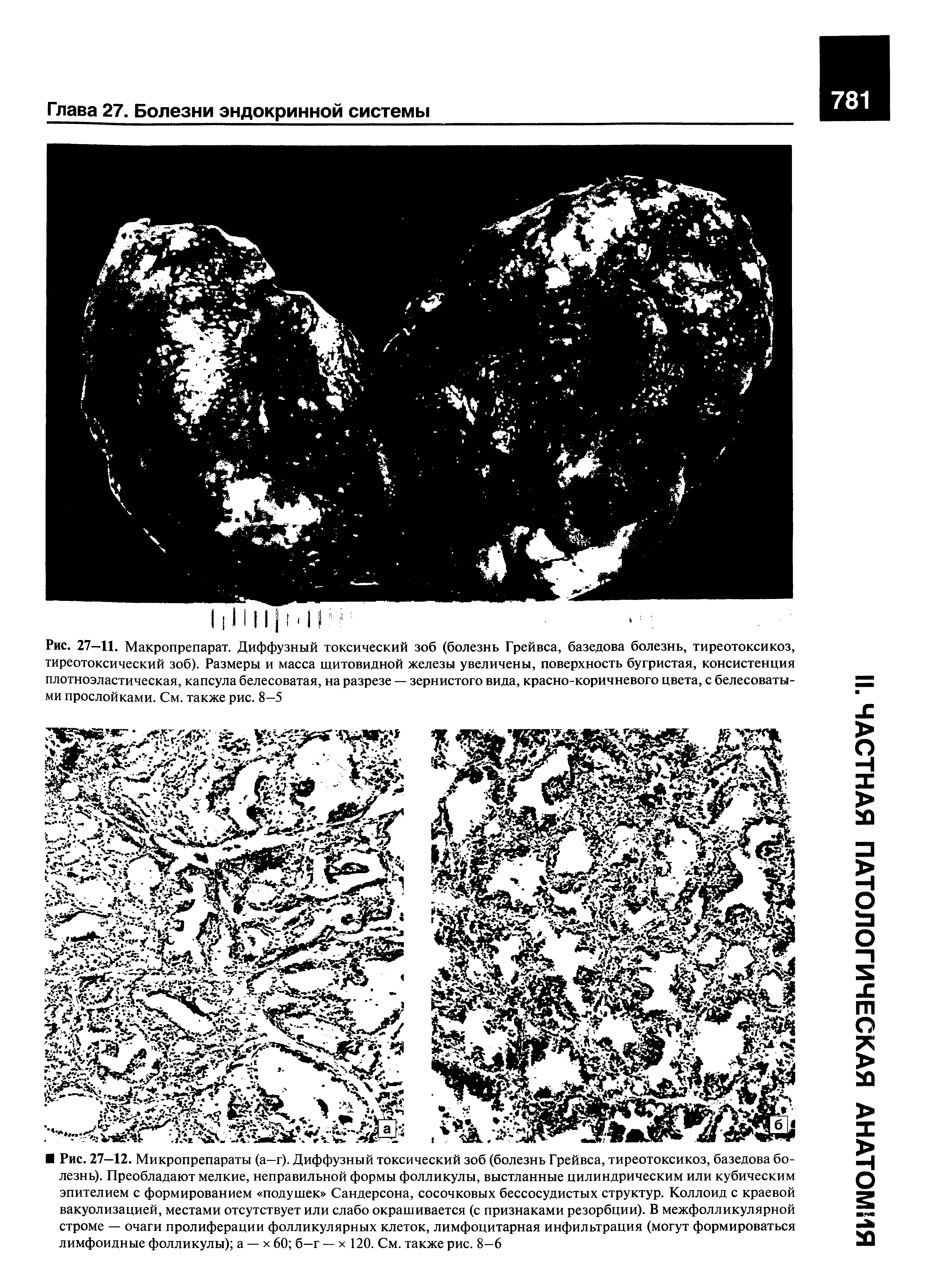 Рис. 27—11. Макропрепарат. Диффузный токсический зоб (болезнь Грейвса, базедова болезнь, тиреотоксикоз, тиреотоксический зоб). Размеры и масса щитовидной железы увеличены, поверхность бугристая, консистенция плотноэластическая, капсула белесоватая, на разрезе — зернистого вида, красно-коричневого цвета, с белесоватыми прослойками. См. также рис. 8-5...