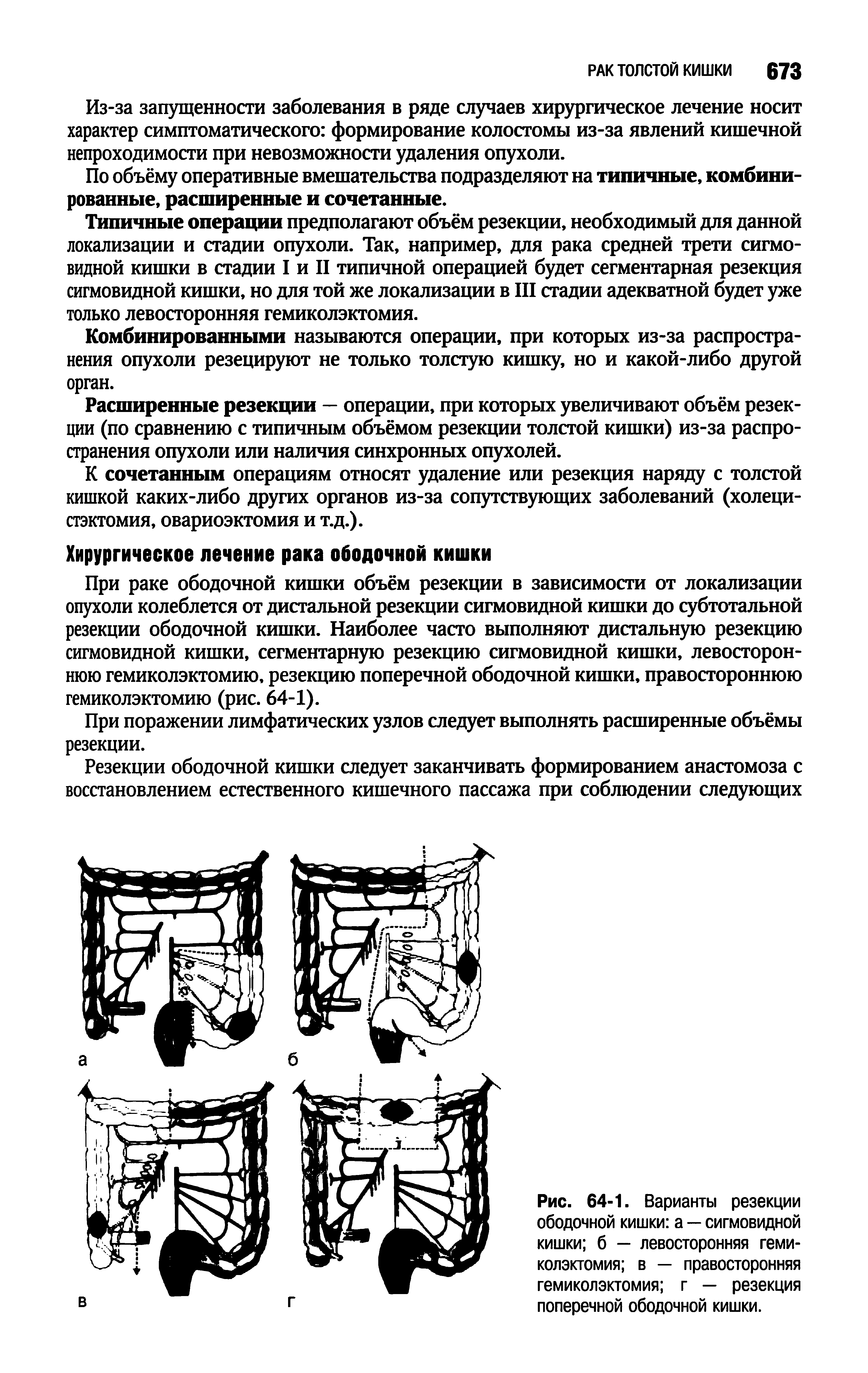 Рис. 64-1. Варианты резекции ободочной кишки а — сигмовидной кишки б — левосторонняя гемиколэктомия в — правосторонняя гемиколэктомия г — резекция поперечной ободочной кишки.