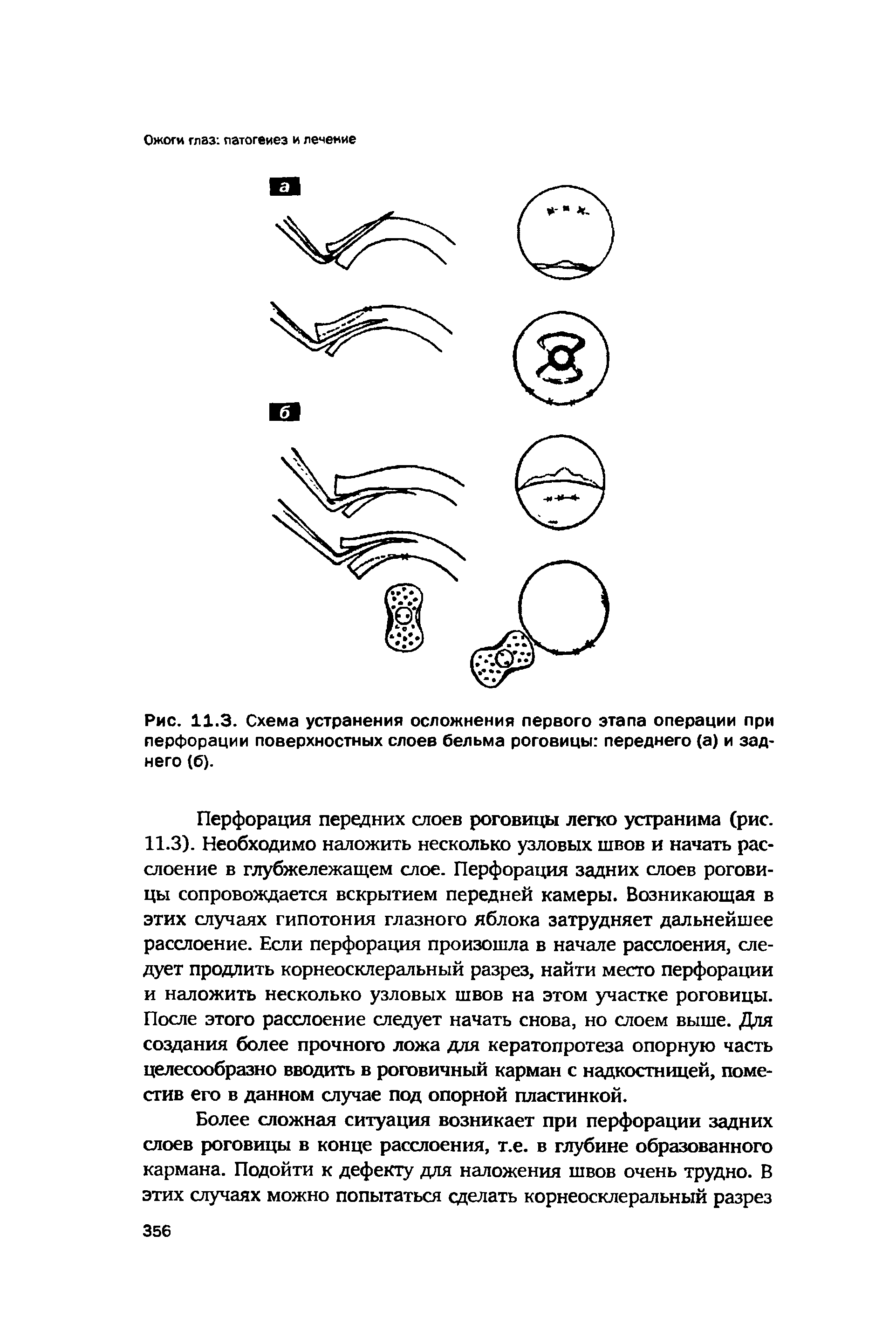 Рис. 11.3. Схема устранения осложнения первого этапа операции при перфорации поверхностных слоев бельма роговицы переднего (а) и заднего (б).