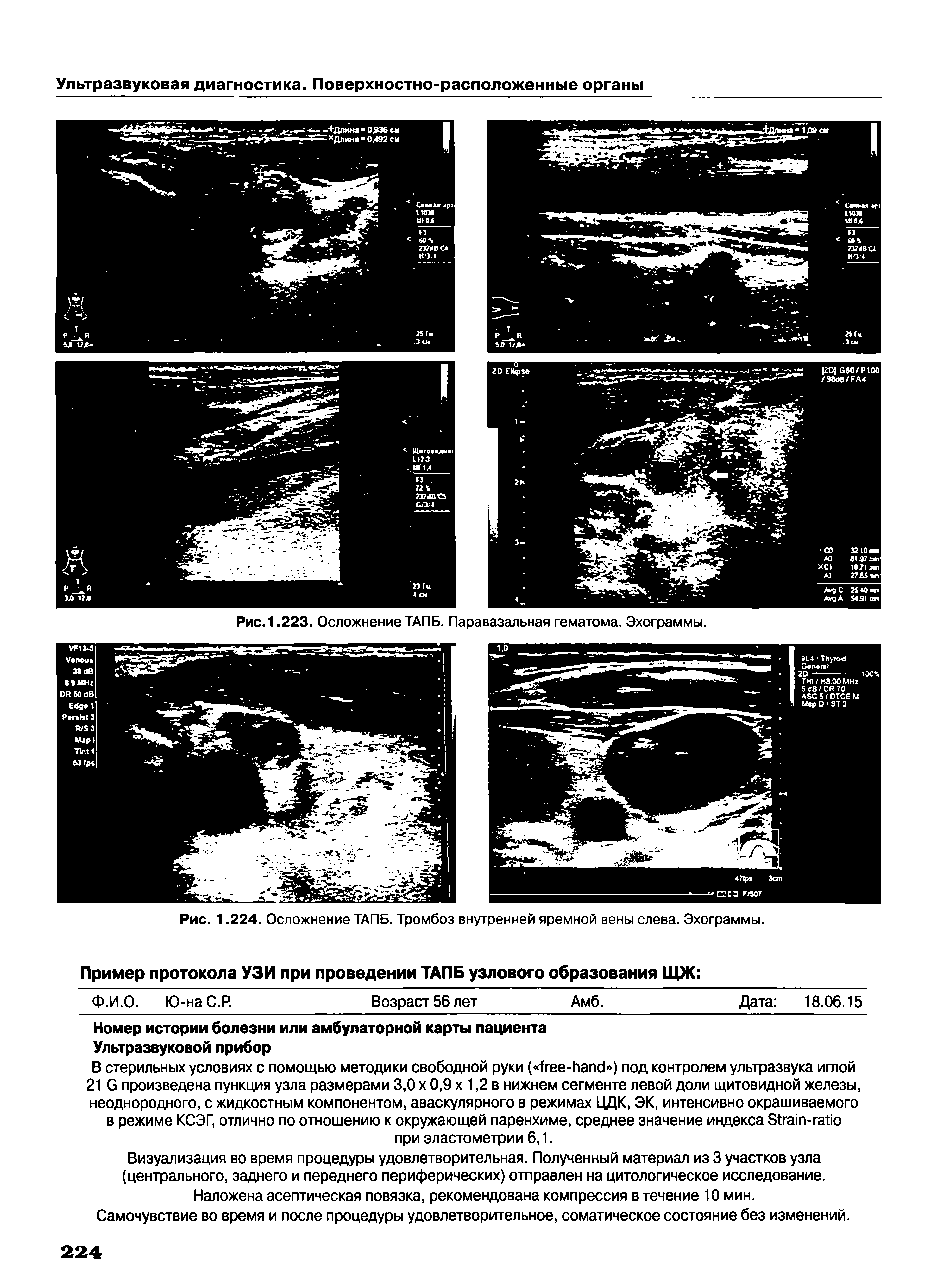 Рис. 1.224. Осложнение ТАПБ. Тромбоз внутренней яремной вены слева. Эхограммы.