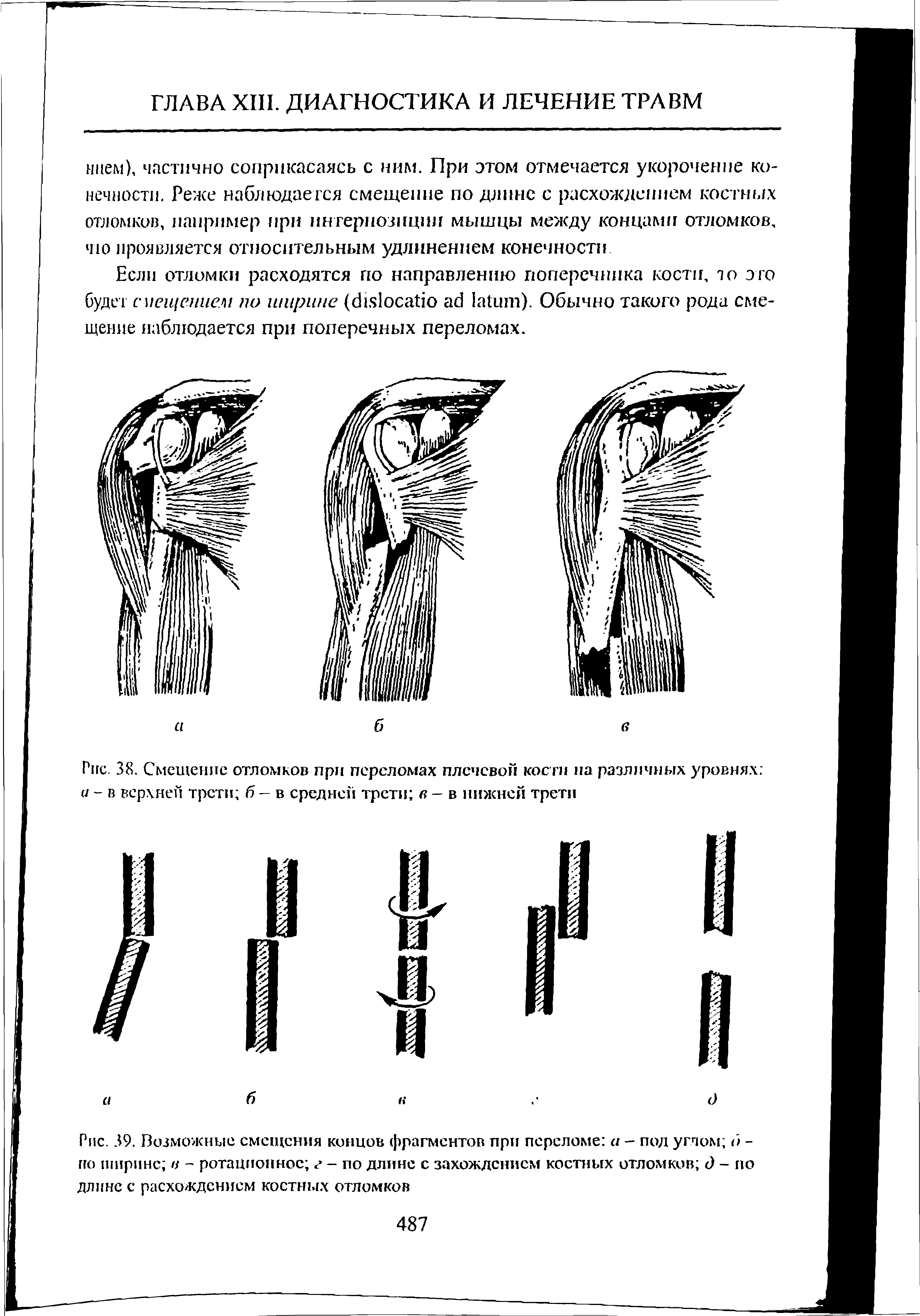 Рис. 38. Смешение отломков при переломах плечевой кости на различных уровнях и - в верхней трети б — в средней трети в — в нижней трети...