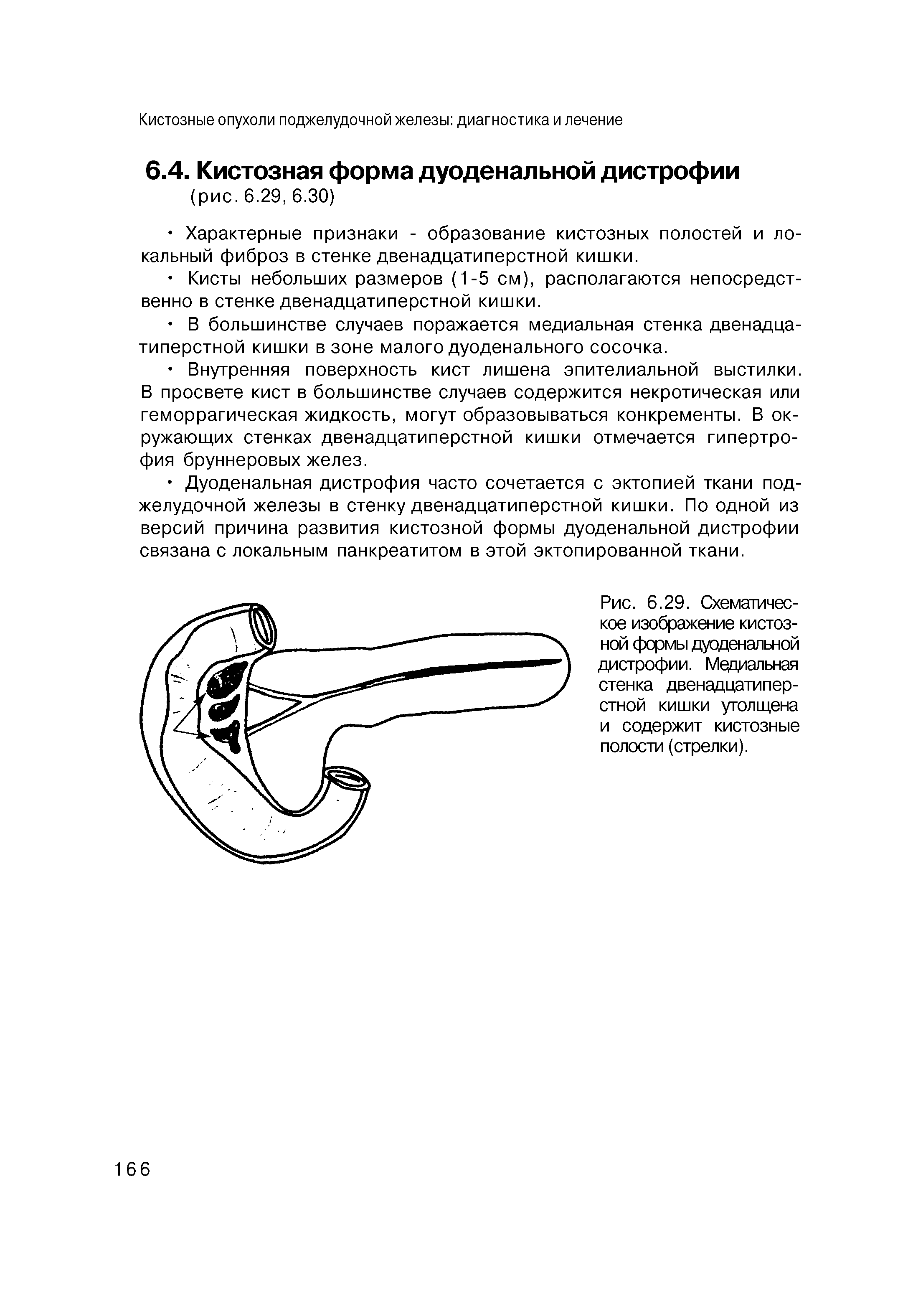 Рис. 6.29. Схематическое изображение кистозной формы дуоденальной дистрофии. Медиальная стенка двенадцатиперстной кишки утолщена и содержит кистозные полости (стрелки).