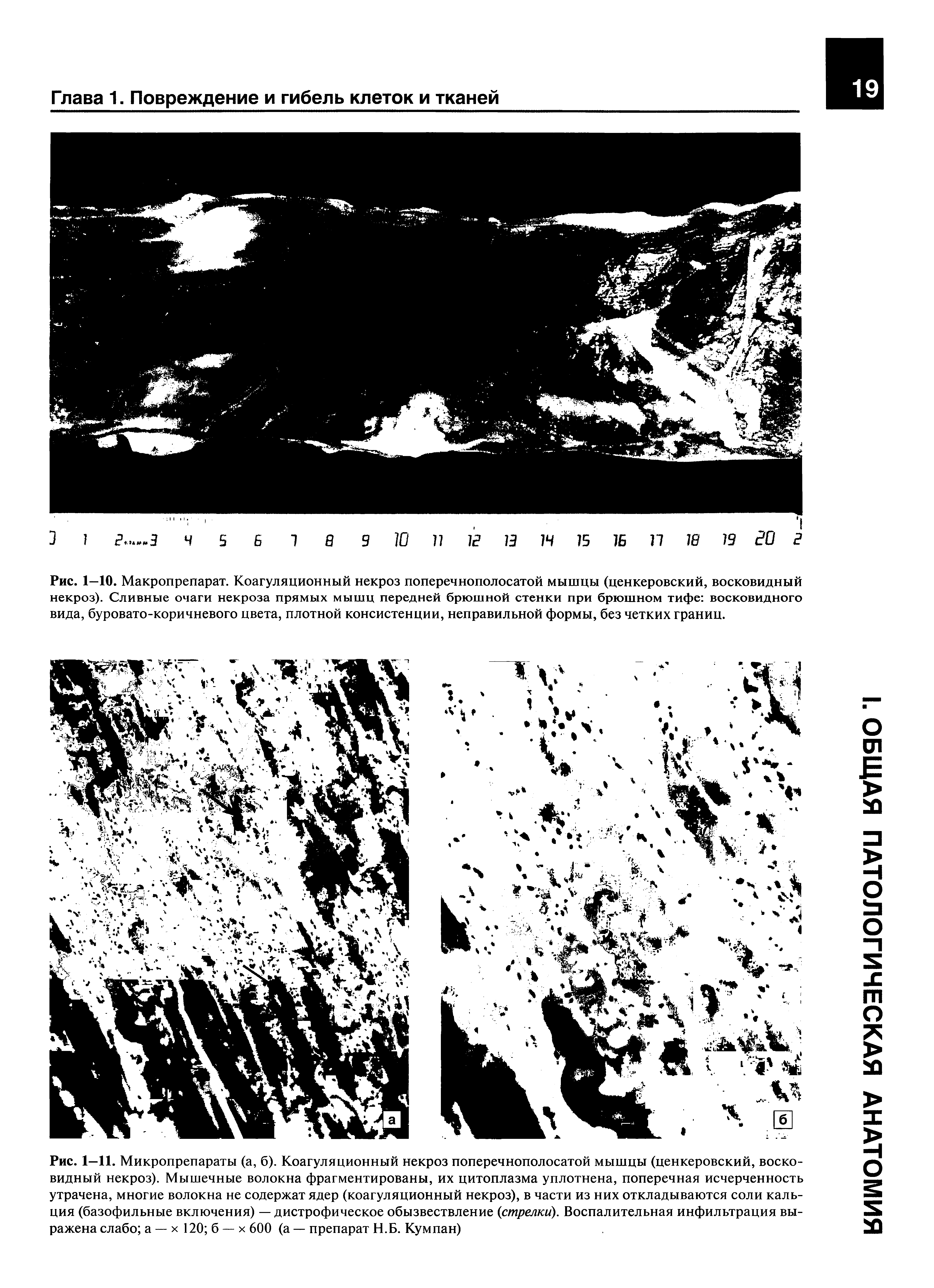 Рис. 1—11. Микропрепараты (а, б). Коагуляционный некроз поперечнополосатой мышцы (ценкеровский, восковидный некроз). Мышечные волокна фрагментированы, их цитоплазма уплотнена, поперечная исчерченность утрачена, многие волокна не содержат ядер (коагуляционный некроз), в части из них откладываются соли кальция (базофильные включения) — дистрофическое обызвествление (стрелки). Воспалительная инфильтрация выражена слабо а — х 120 б — х 600 (а — препарат Н.Б. Кумпан)...