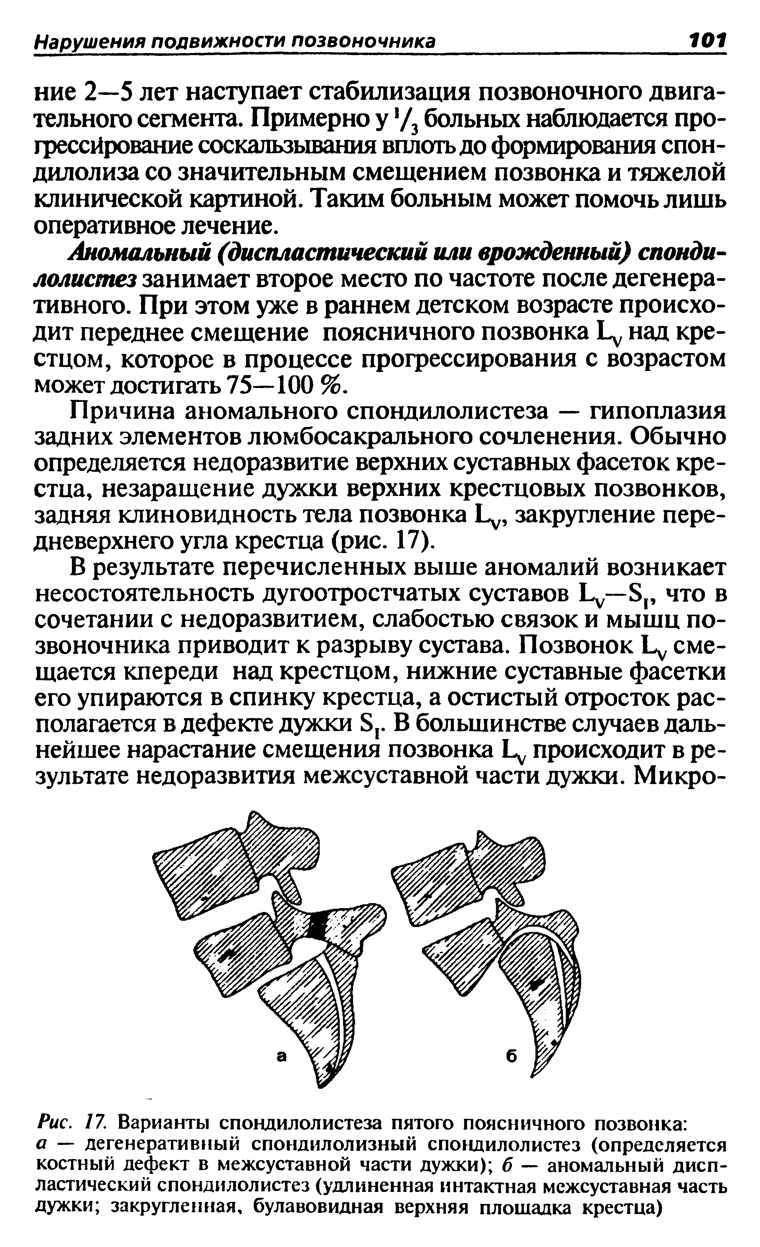 Рис. 17. Варианты спондилолистеза пятого поясничного позвонка а — дегенеративный спондилолизный спондилолистез (определяется костный дефект в межсуставной части дужки) б — аномальный диспластический спондилолистез (удлиненная интактная межсуставная часть дужки закругленная, булавовидная верхняя площадка крестца)...