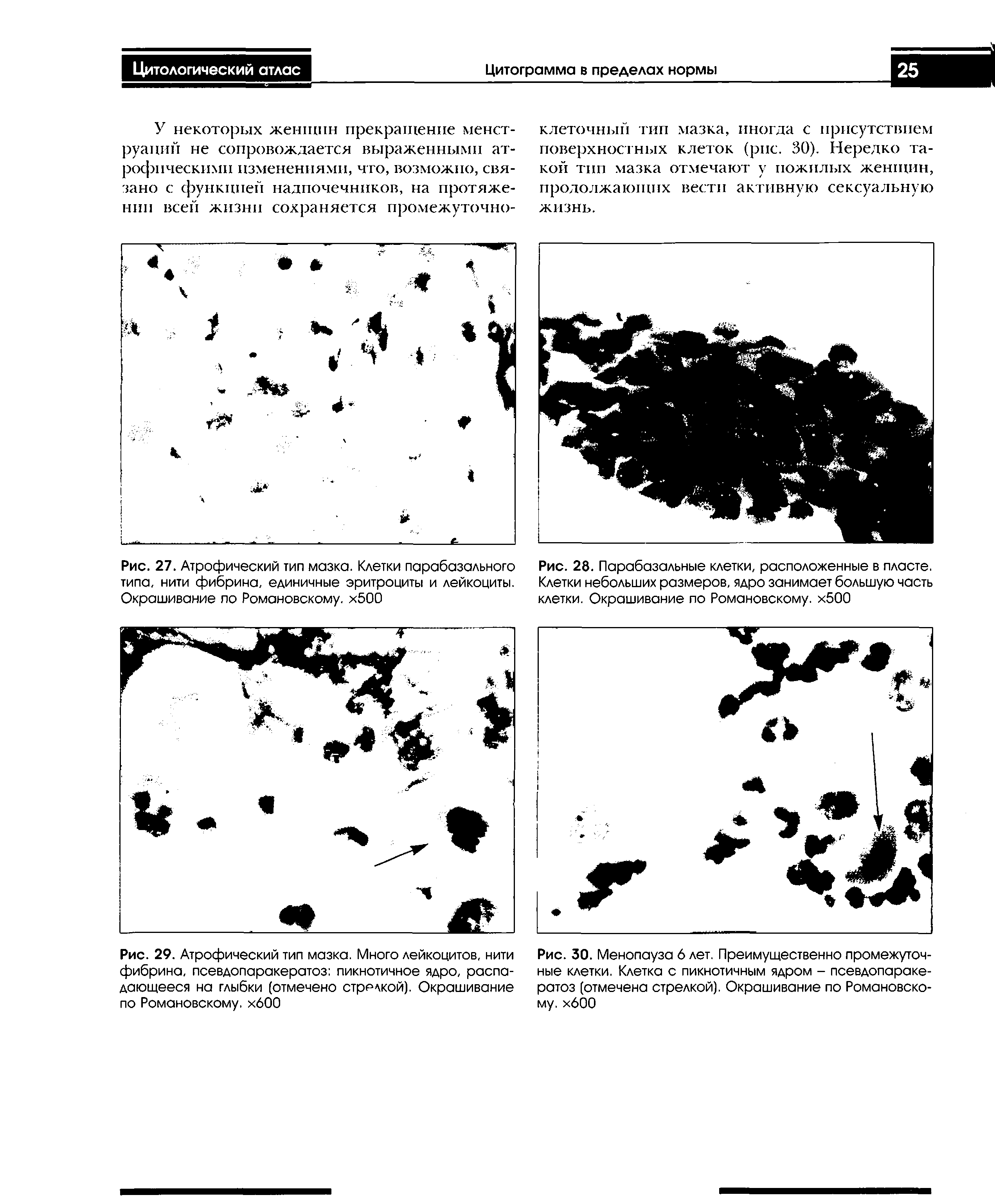 Рис. 27. Атрофический тип мазка. Клетки парабазального типа, нити фибрина, единичные эритроциты и лейкоциты. Окрашивание по Романовскому. х500...