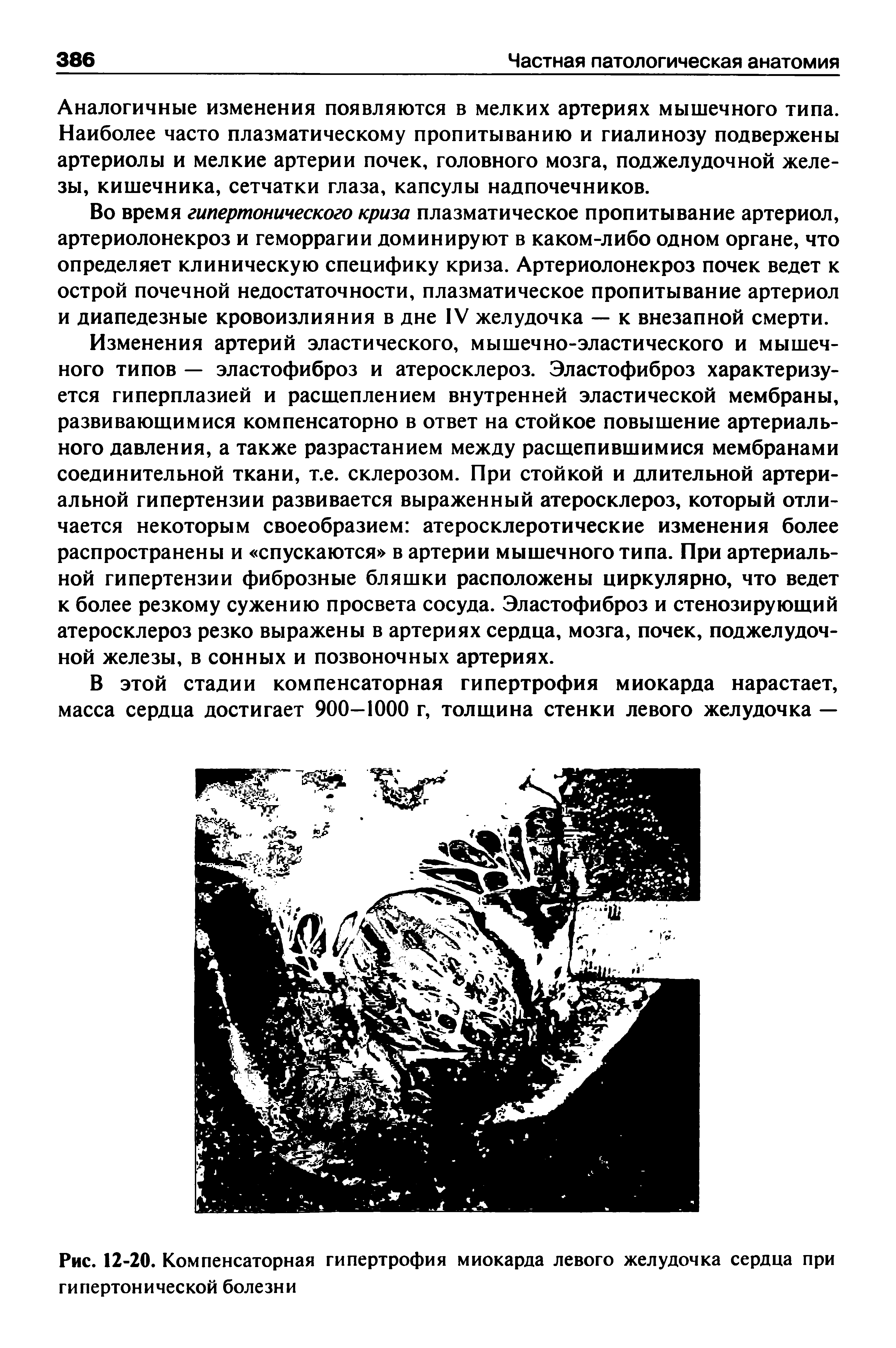 Рис. 12-20. Компенсаторная гипертрофия миокарда левого желудочка сердца при гипертонической болезни...