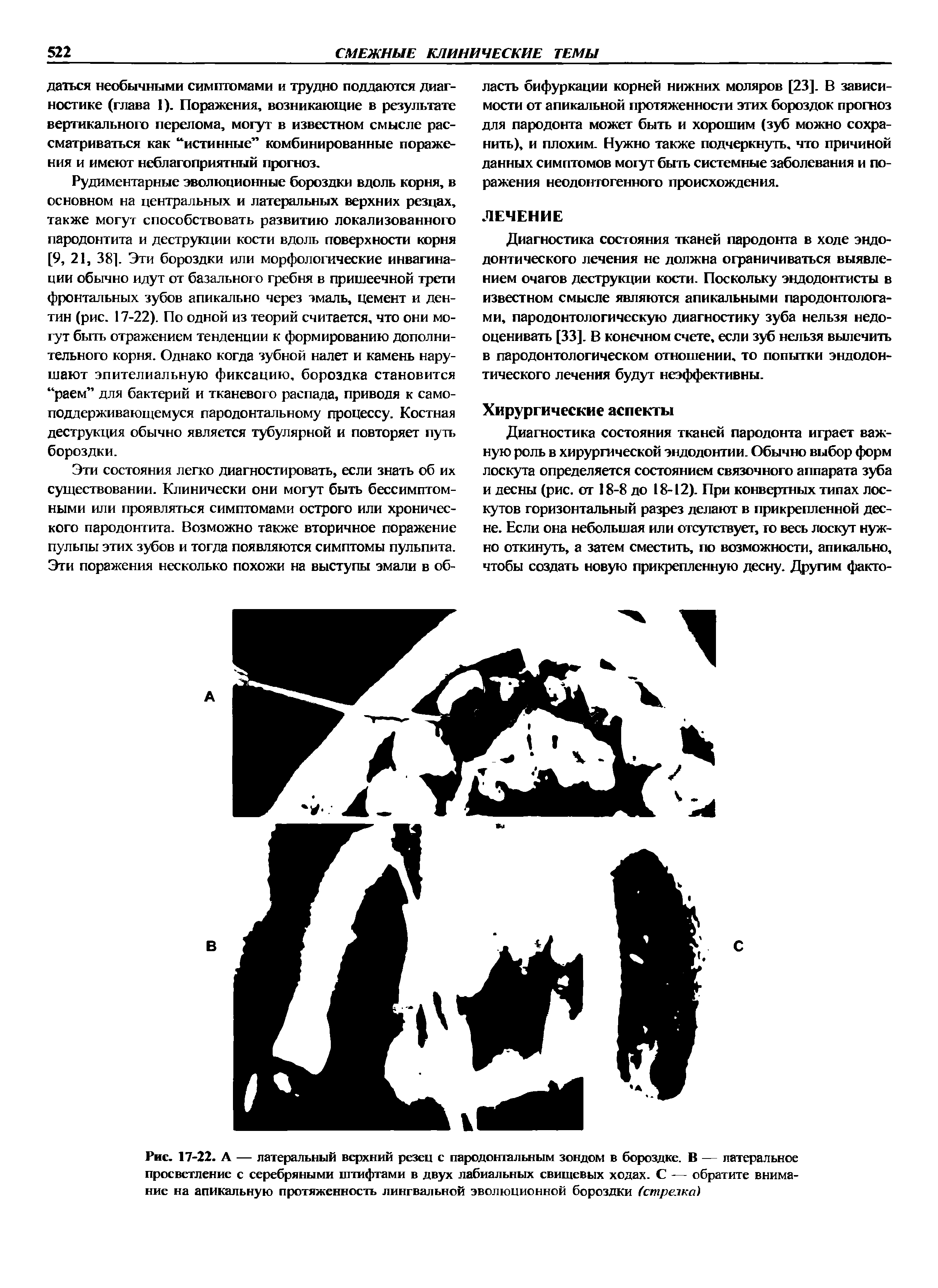 Рис. 17-22. А — латеральный верхний резец с пародонгальным зондом в бороздке. В — латеральное просветление с серебряными штифтами в двух лабиальных свищевых ходах. С — обратите внимание на апикальную протяженность лингвальной эволюционной бороздки (стрелка ...