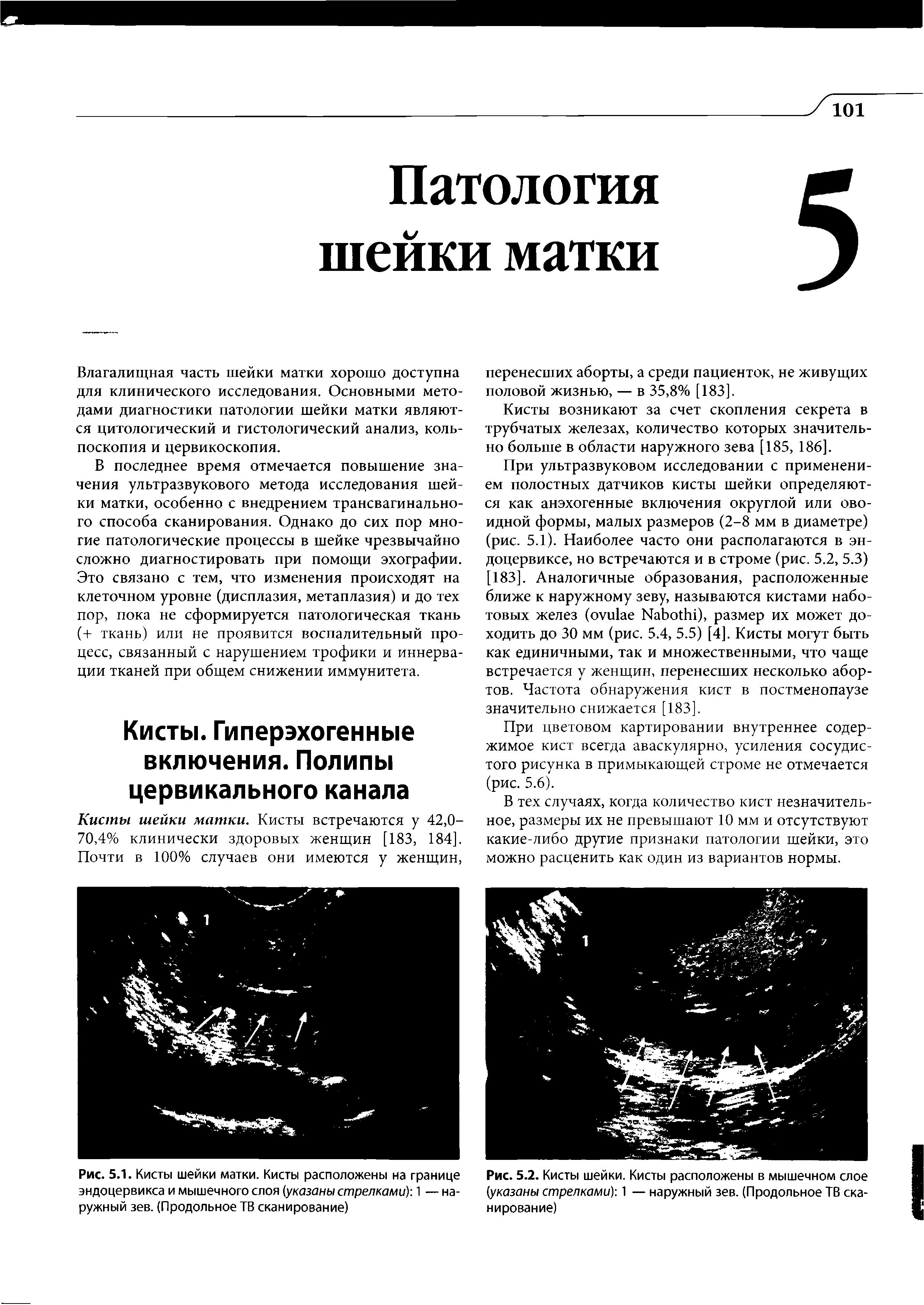 Рис. 5.1. Кисты шейки матки. Кисты расположены на границе эндоцервикса и мышечного слоя (указаны стрелками) 1 — наружный зев. (Продольное ТВ сканирование)...