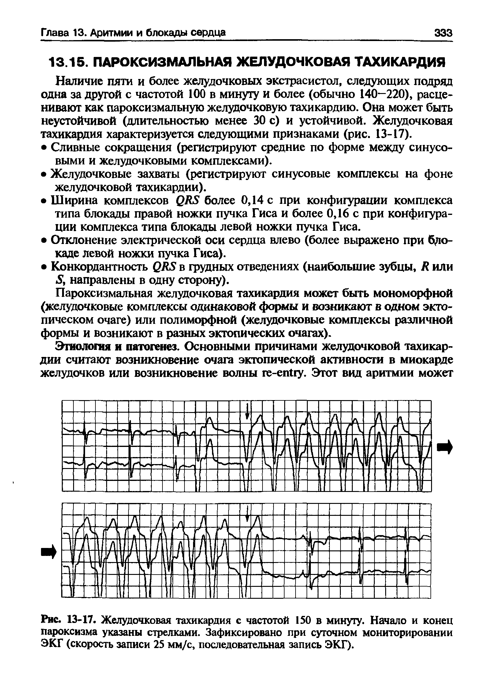 Рис. 13-17. Желудочковая тахикардия с частотой 150 в минуту. Начало и конец пароксизма указаны стрелками. Зафиксировано при суточном мониторировании ЭКГ (скорость записи 25 мм/с, последовательная запись ЭКГ).