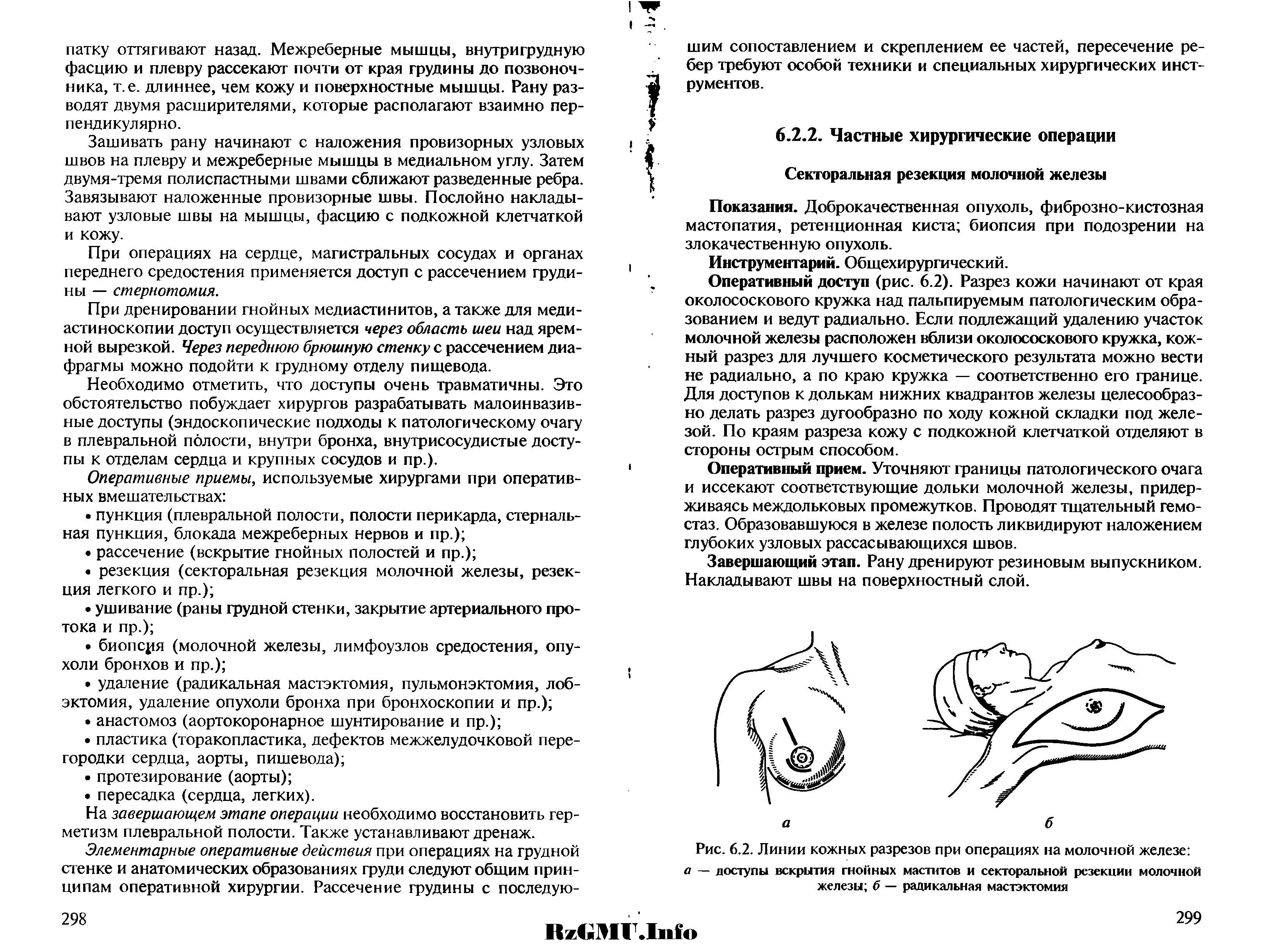 Секторальная резекция молочных желез. Протокол операции резекция молочной железы-. Секторальная резекция молочной железы протокол операции. Операция секторальная резекция молочной железы. Секторальная резекция молочной железы хирургия.