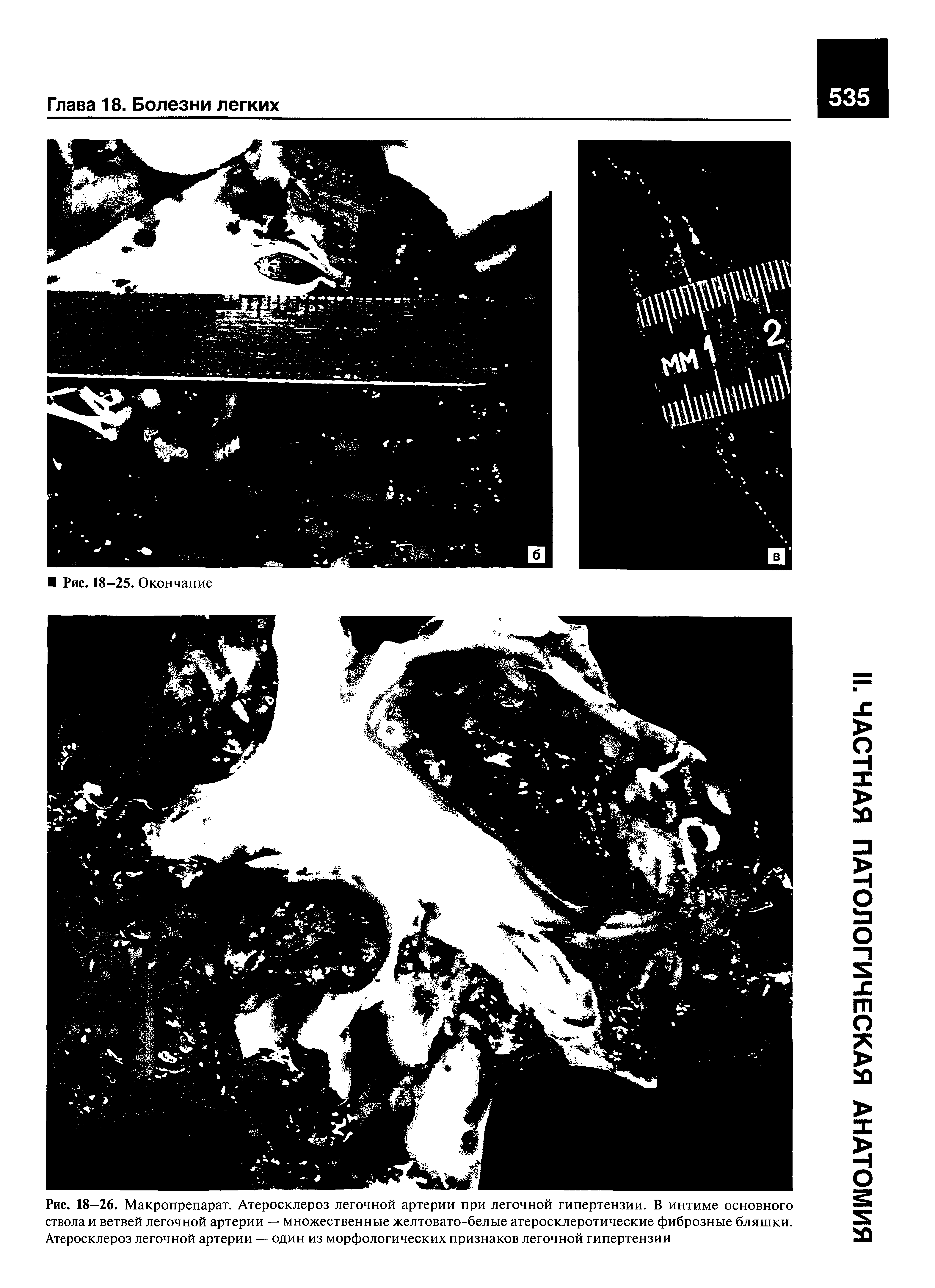 Рис. 18-26. Макропрепарат. Атеросклероз легочной артерии при легочной гипертензии. В интиме основного ствола и ветвей легочной артерии — множественные желтовато-белые атеросклеротические фиброзные бляшки. Атеросклероз легочной артерии — один из морфологических признаков легочной гипертензии...