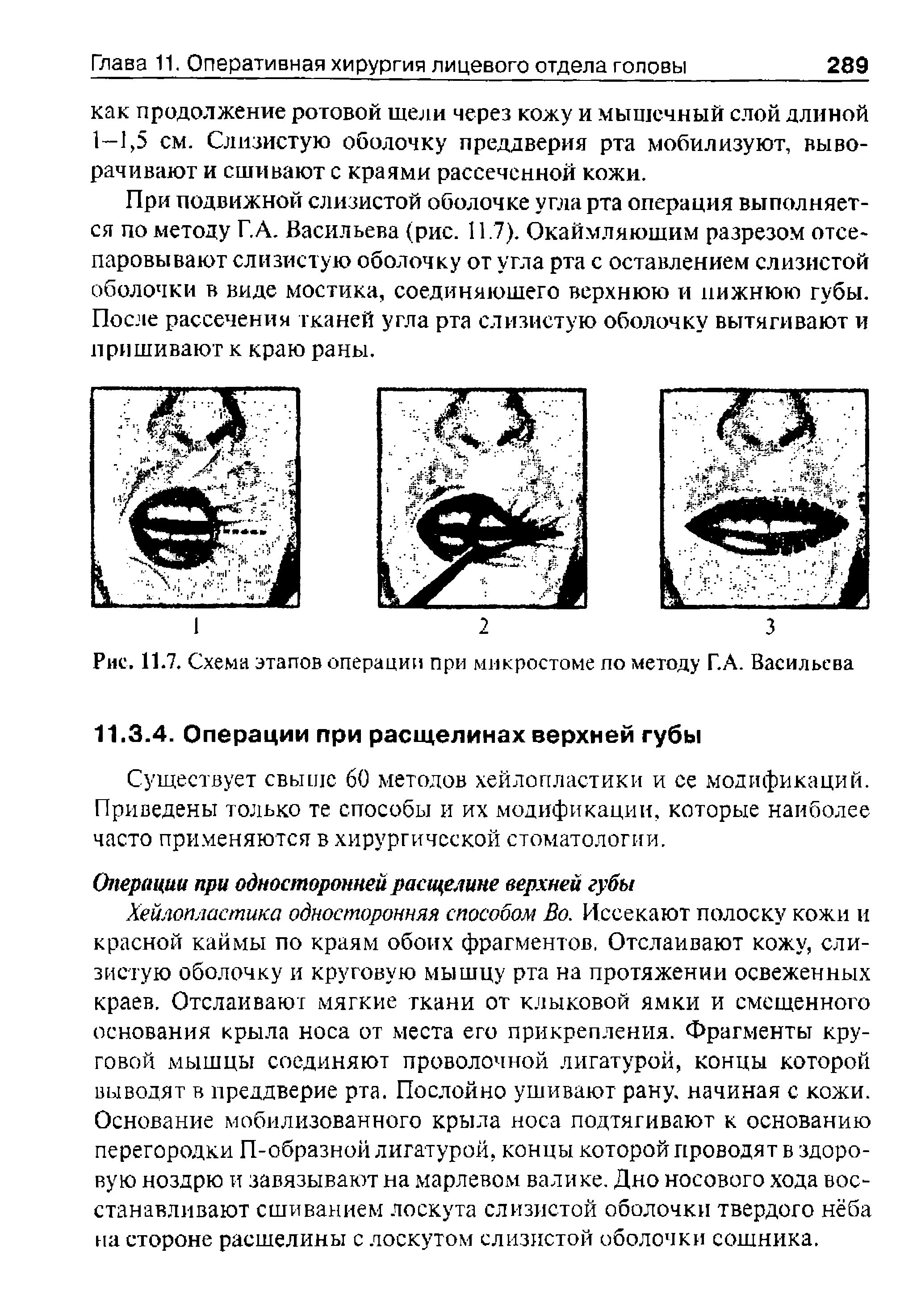 Рис. 11.7. Схема этапов операции при микростоме по методу Г.А. Васильева...