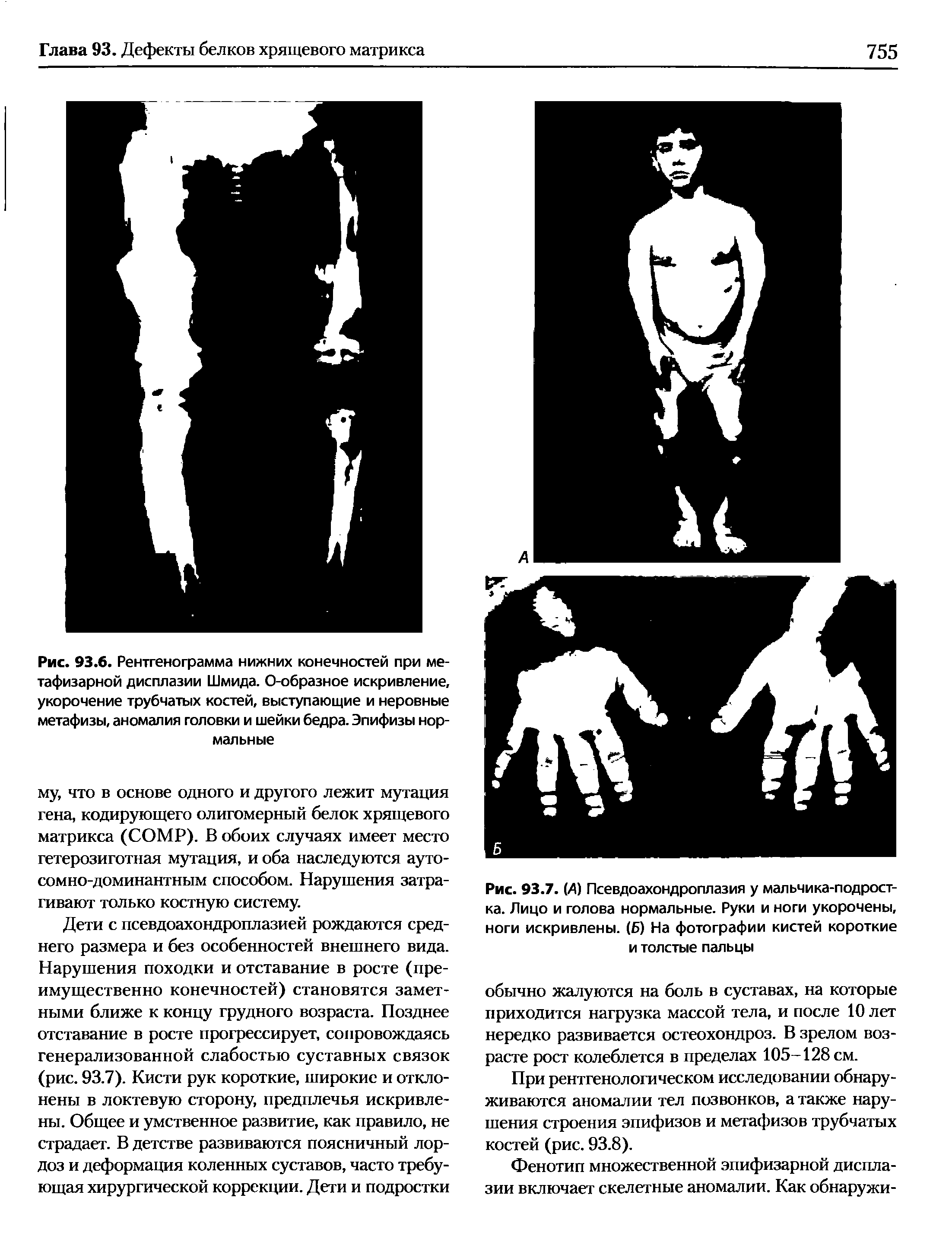 Рис. 93.7. (Д) Псевдоахондроплазия у мальчика-подростка. Лицо и голова нормальные. Руки и ноги укорочены, ноги искривлены. (Б) На фотографии кистей короткие и толстые пальцы...