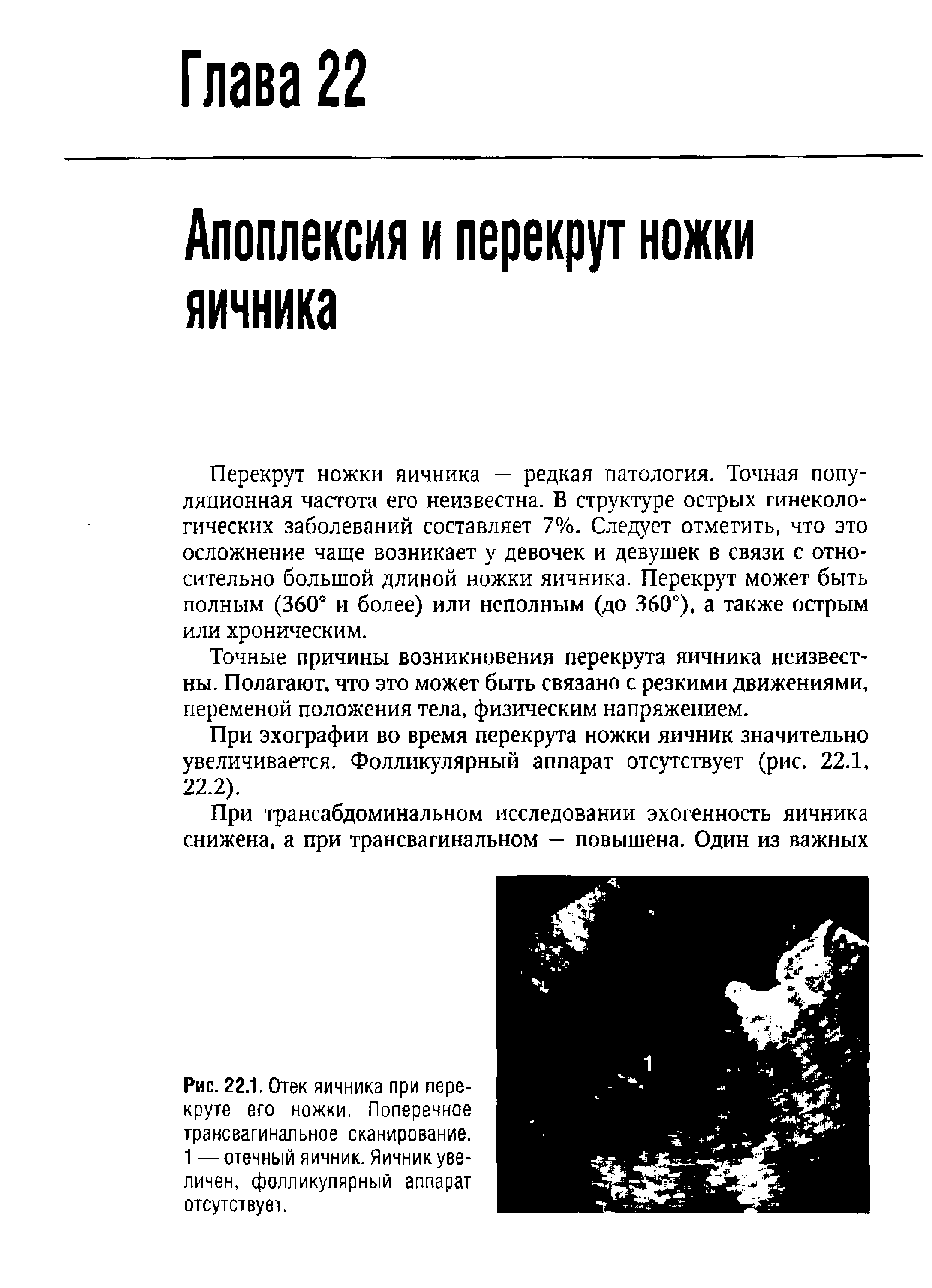 Рис. 22.1. Отек яичника при пере-круте его ножки. Поперечное трансвагинальное сканирование. 1 — отечный яичник. Яичник увеличен, фолликулярный аппарат отсутствует.