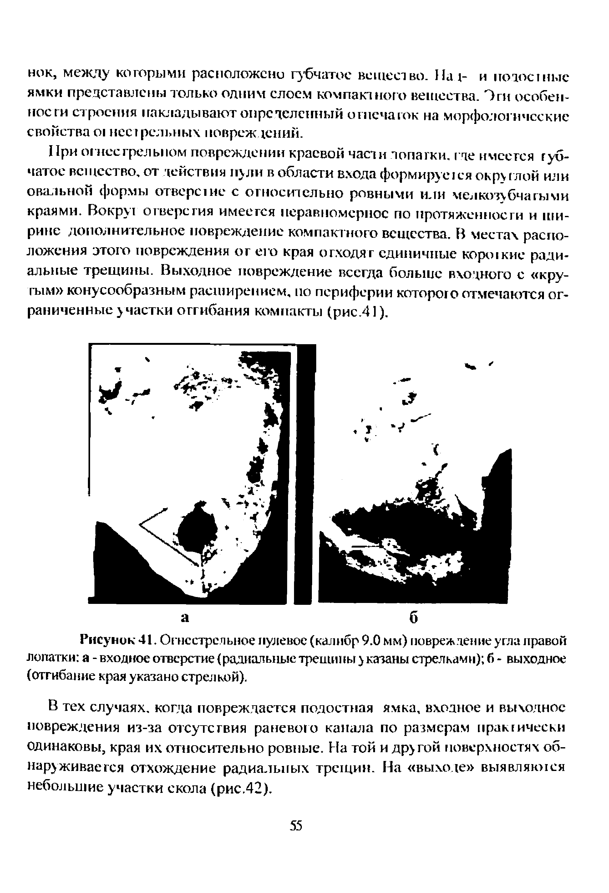 Рисунок 41. Огнестрельное пулевое (калибр 9.0 мм) повреж дение угла правой лопатки а - входное отверстие (радиальные трещины у казаны стрелками) б - выходное (отгибание края указано стрелкой).