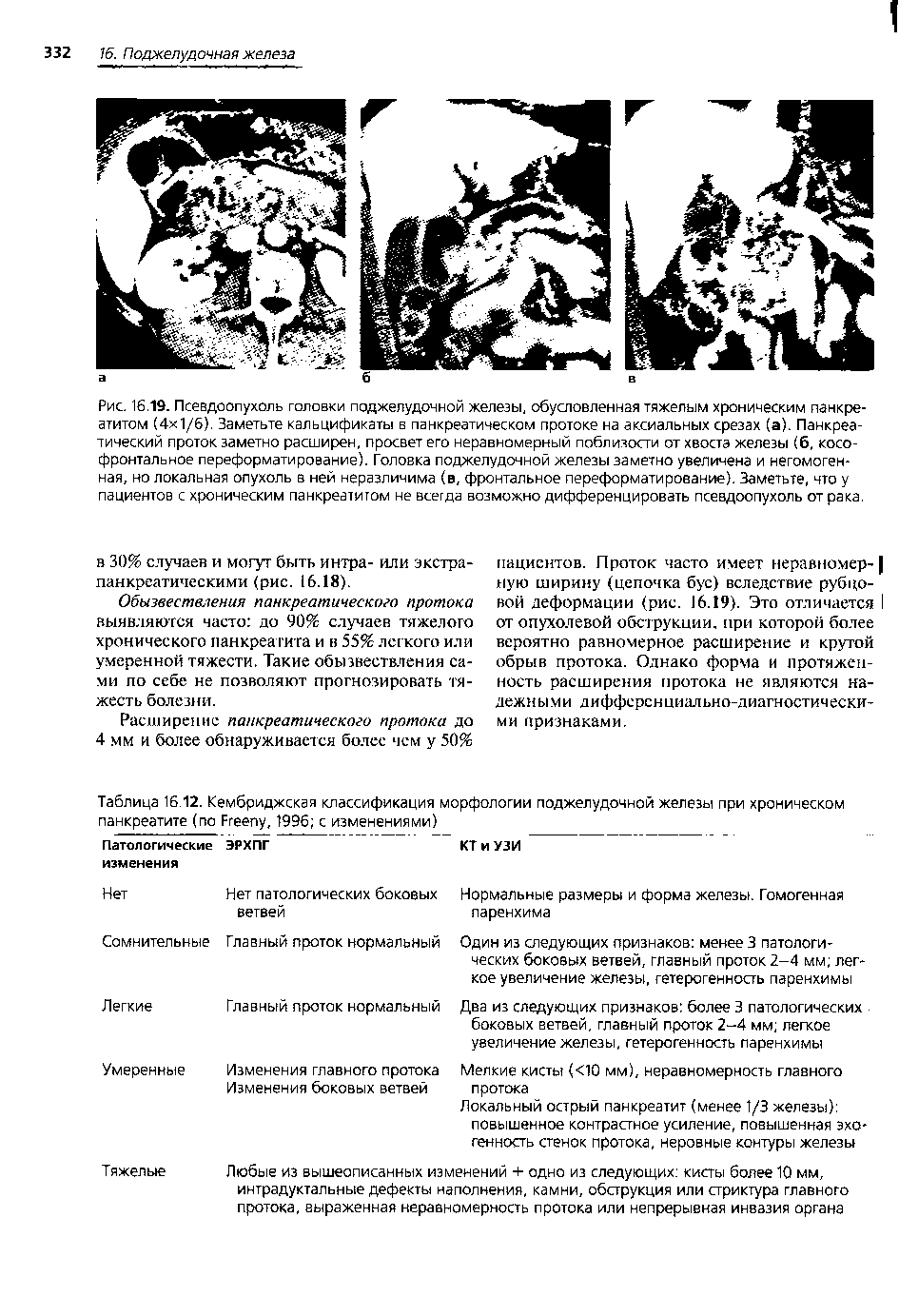 Таблица 16 12. Кембриджская классификация морфологии поджелудочной железы при хроническом панкреатите (по Ргеепу, 1996 с изменениями)...