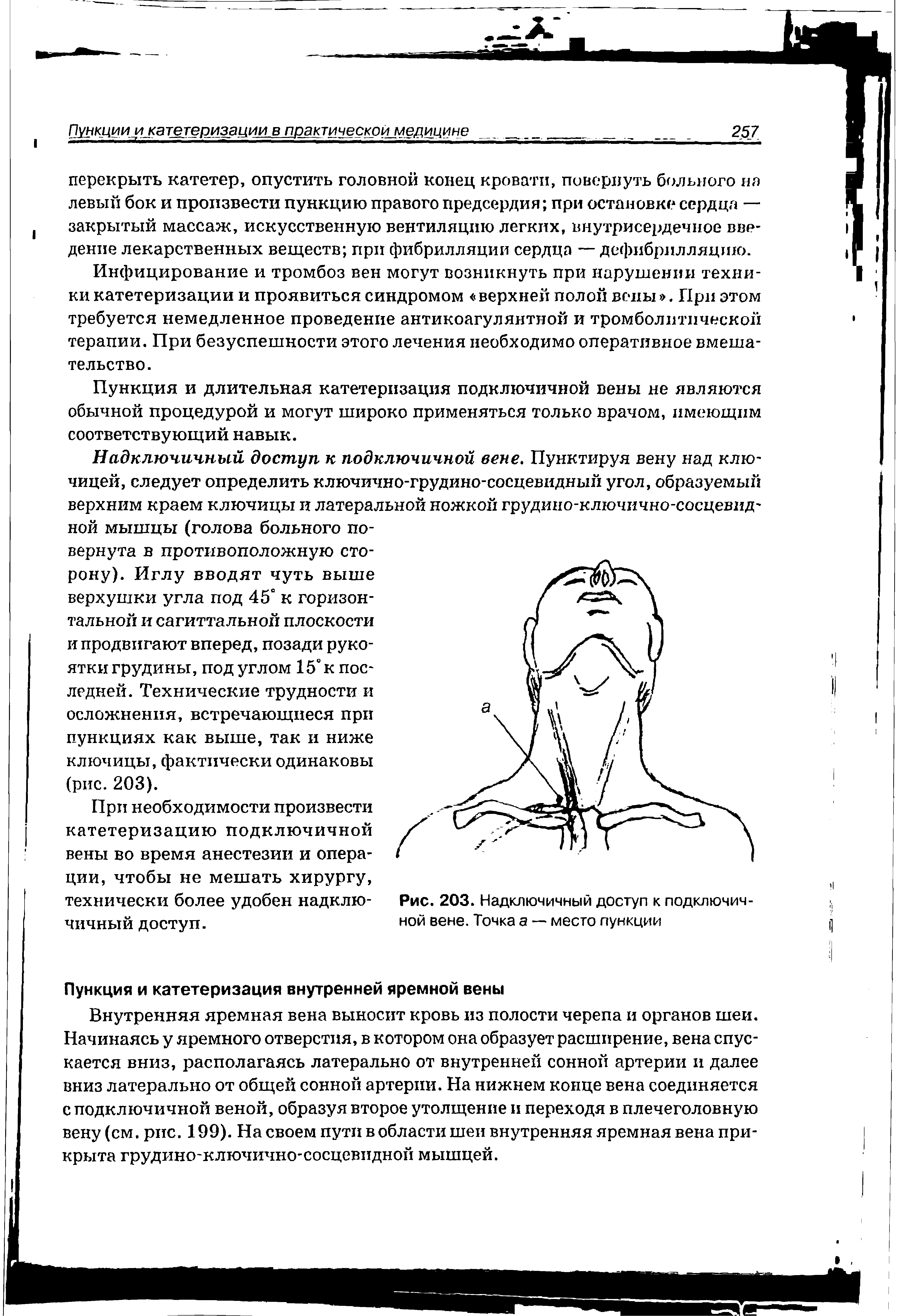 Рис. 203. Надключичный доступ к подключичной вене. Точка а — место пункции...