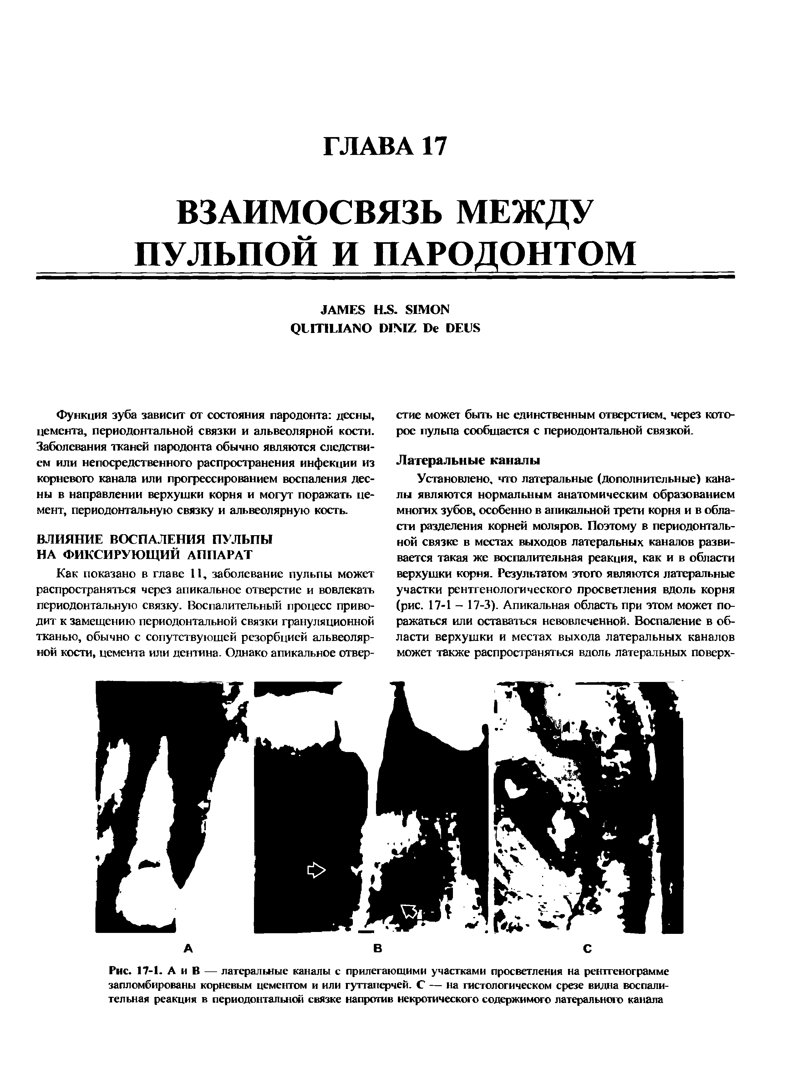 Рис. 17-1. А и В — латеральные каналы с прилегающими участками просветления на рентгенограмме запломбированы корневым цементом и или гуттаперчей. С — на гистологическом срезе видна воспалительная реакция в периодонтальной связке напротив некротического содержимого латерального канала...