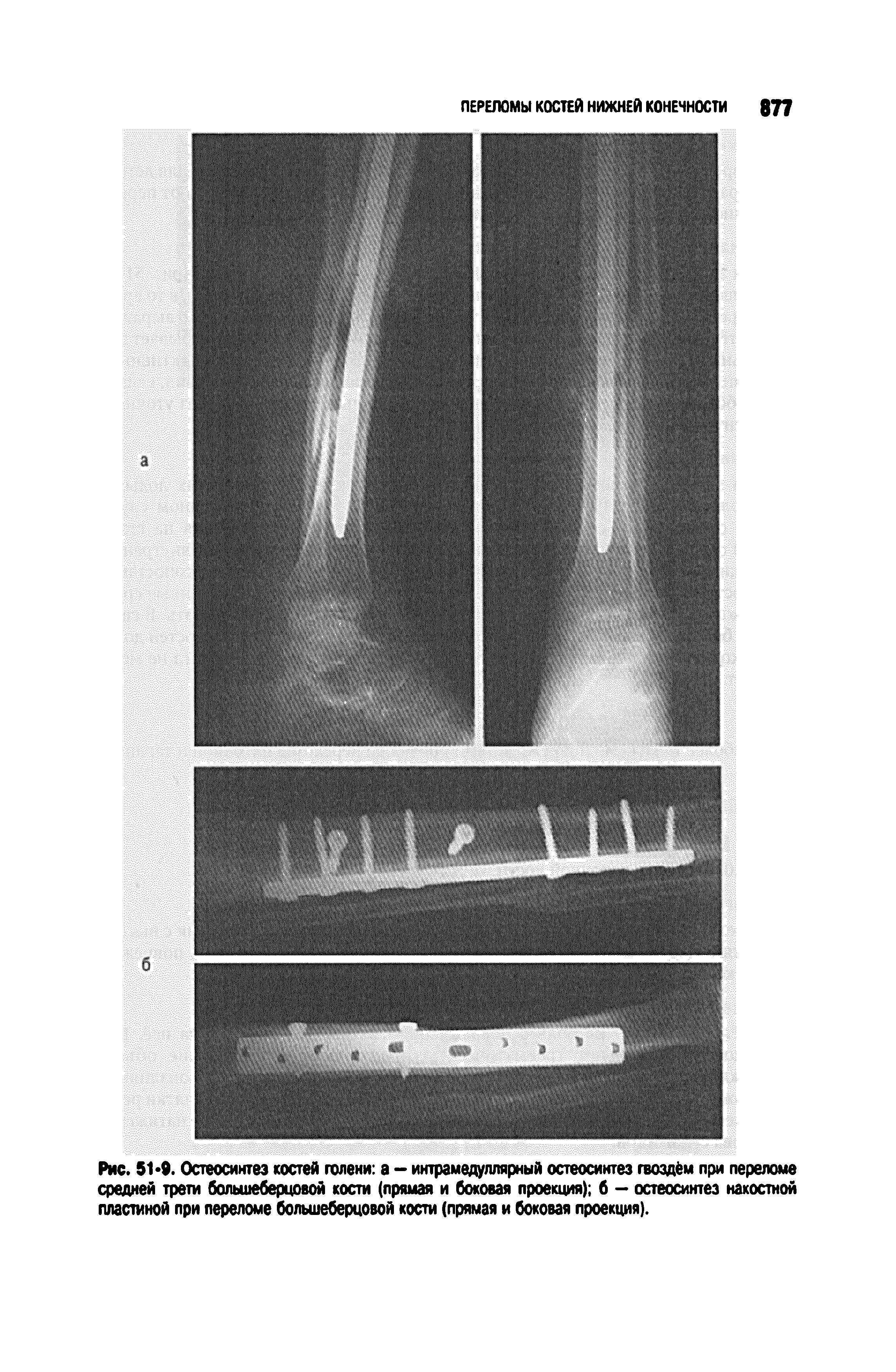 Рис. 51 9. Остеосинтез костей голени а - интрамедуллярный остеосинтез гвоздём при переломе средней трети большеберцовой кости (прямая и боковая проекция) б — остеосинтез накостной пластиной при переломе большеберцовой кости (прямая и боковая проекция).