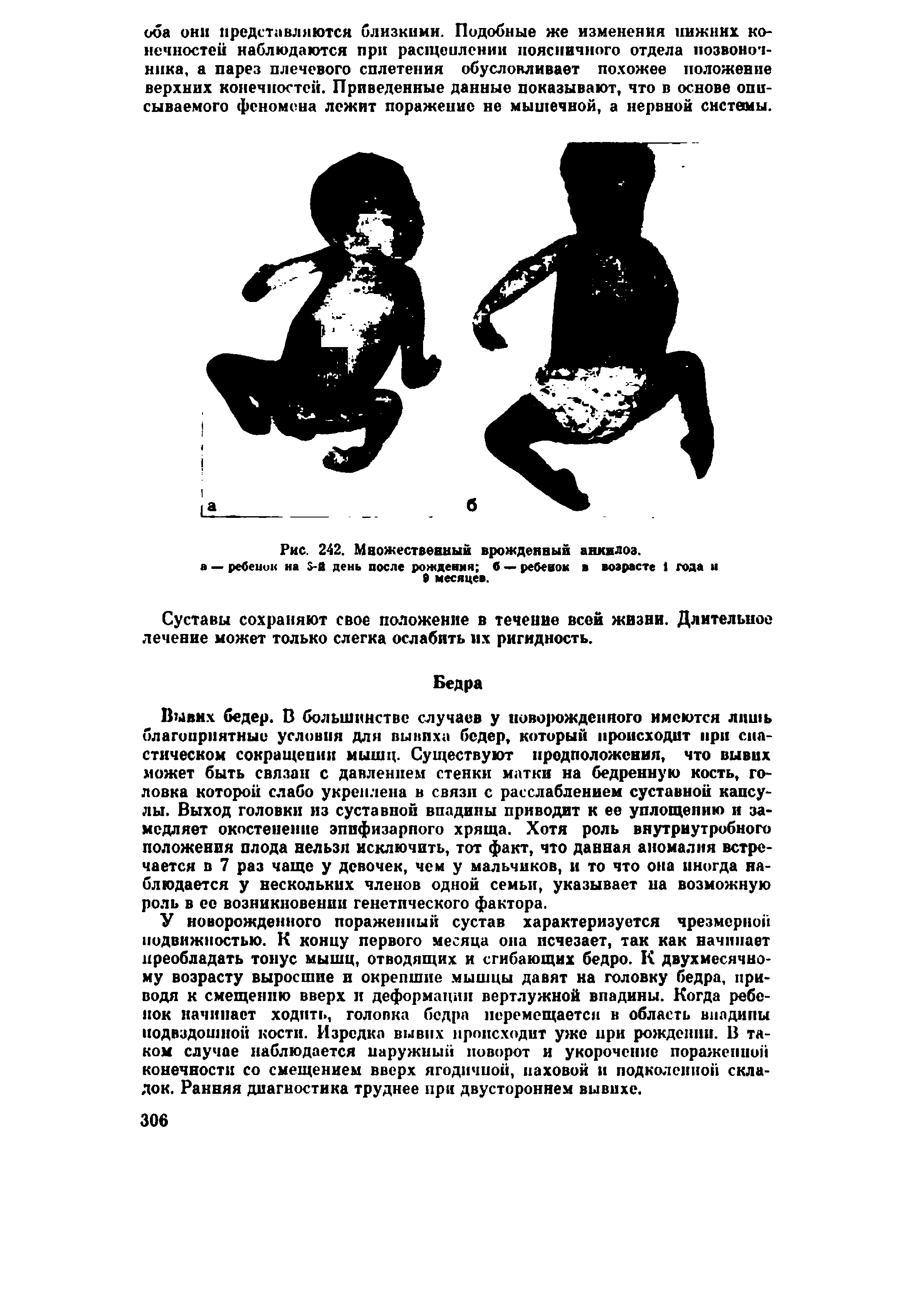 Рис. 242. Множественный врожденный анкнлоз. а — ребенок на -й день после рождения б — ребенок в возрасте 1 года и 8 месяцев.