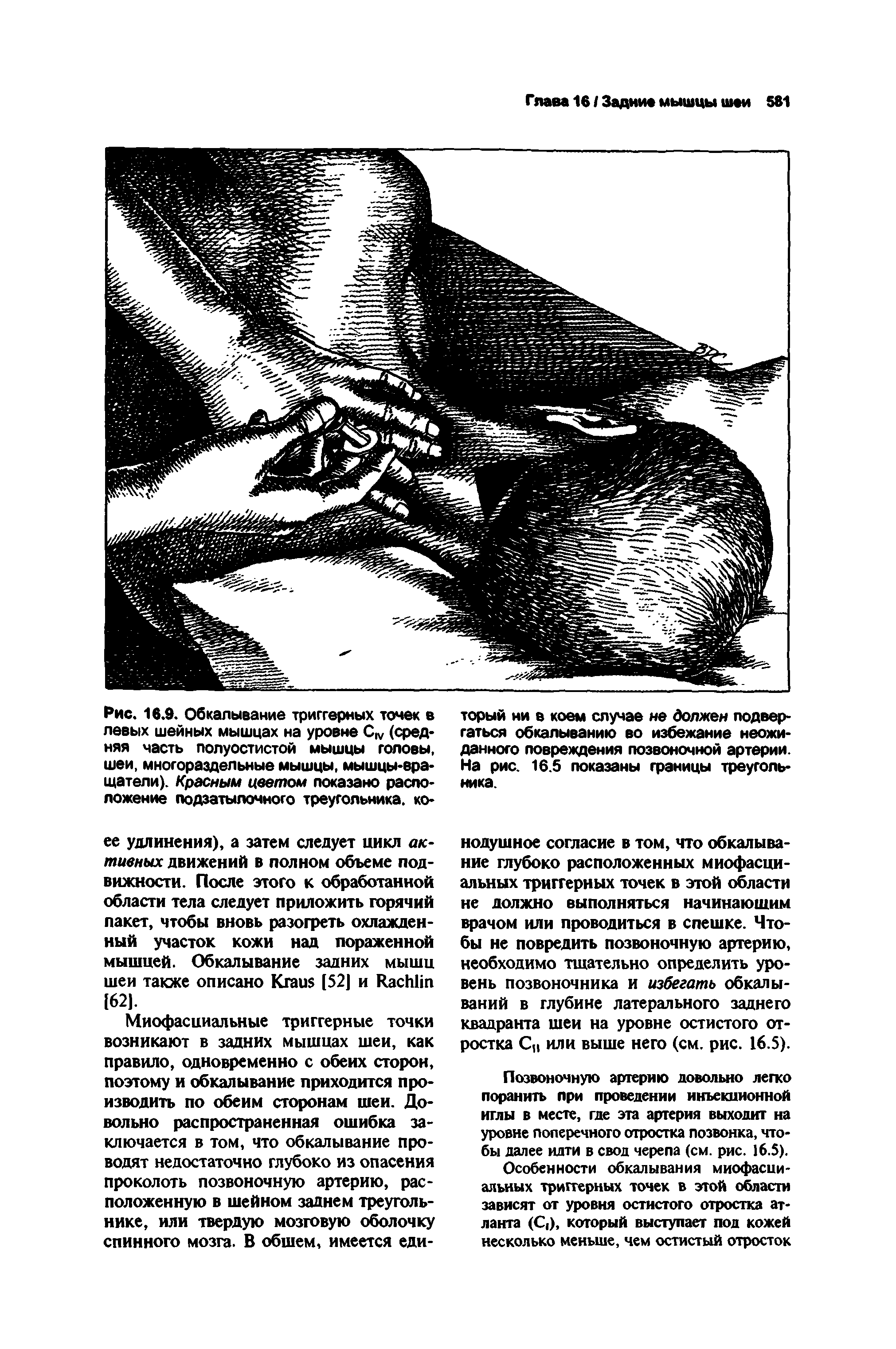 Рис. 16.9. Обкалывание триггерных точек в левых шейных мышцах на уровне (средняя часть полуостистой мышцы головы, шеи, многораздельные мышцы, мышцы-вращатели). Красным цветом показано расположение подзатылочного треугольника, ко...