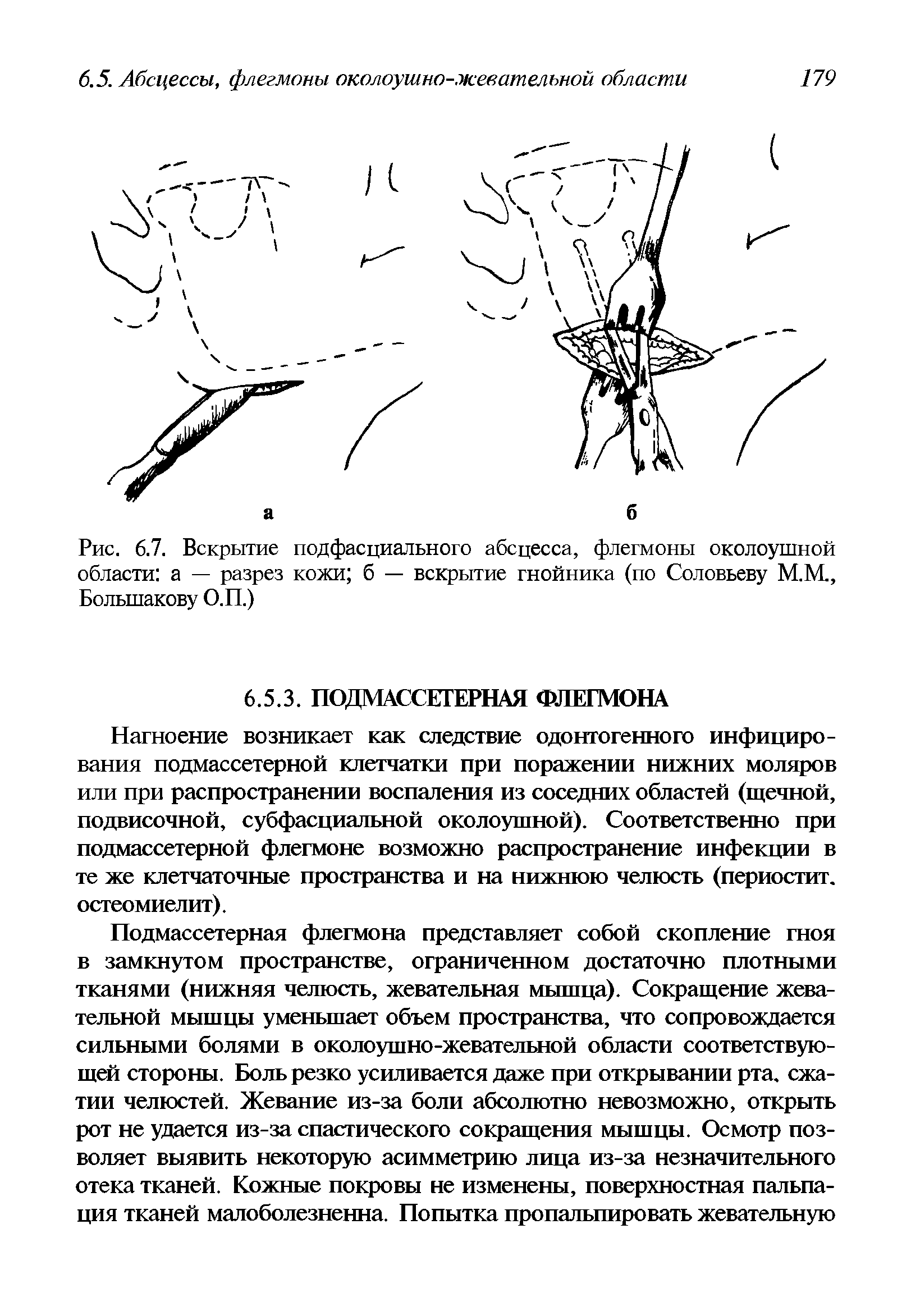 Рис. 6.7. Вскрытие подфасциального абсцесса, флегмоны околоушной области а — разрез кожи б — вскрытие гнойника (по Соловьеву М.М., Большакову О.П.)...