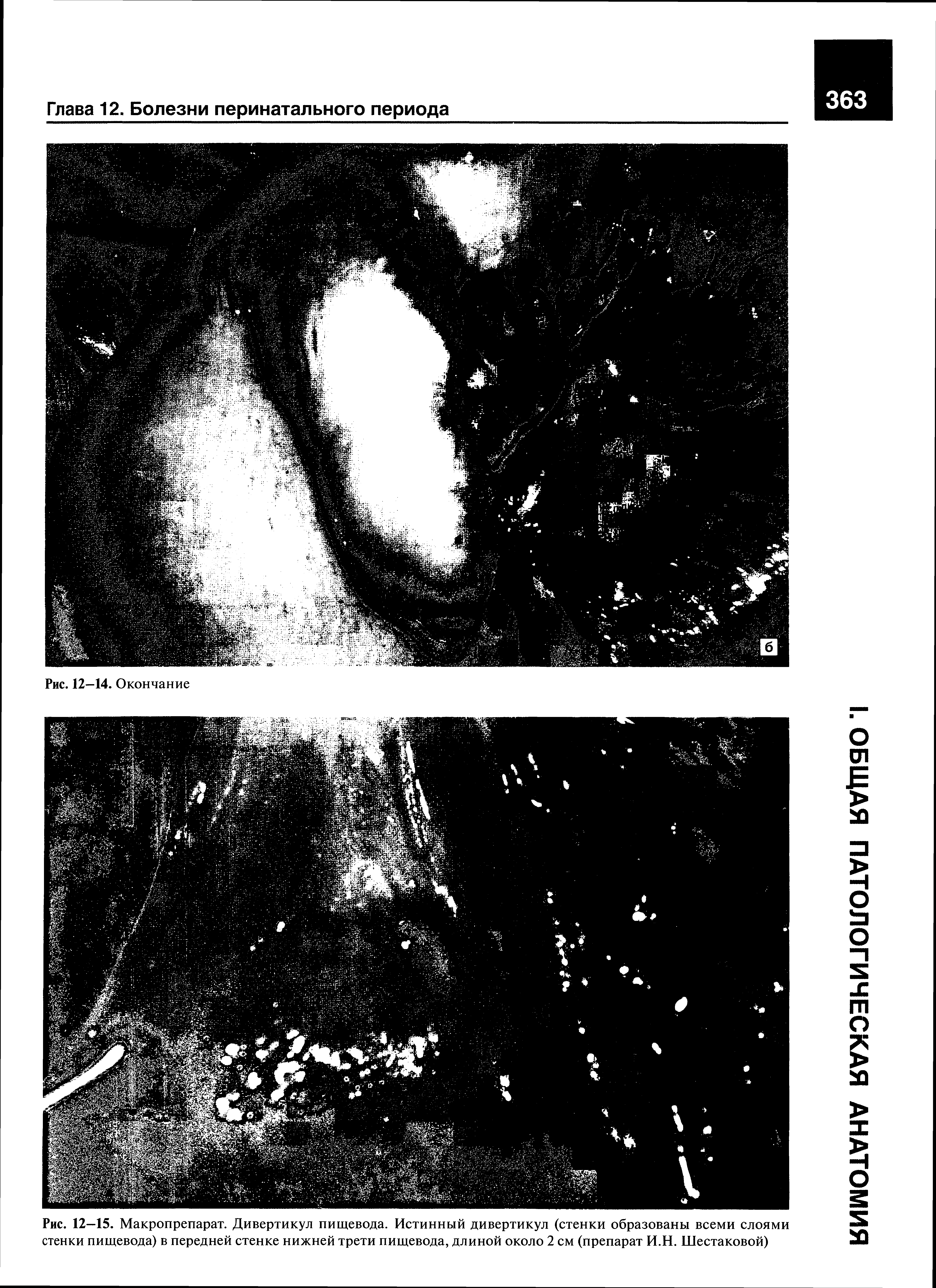 Рис. 12—15. Макропрепарат. Дивертикул пищевода. Истинный дивертикул (стенки образованы всеми слоями стенки пищевода) в передней стенке нижней трети пищевода, длиной около 2 см (препарат И.Н. Шестаковой)...