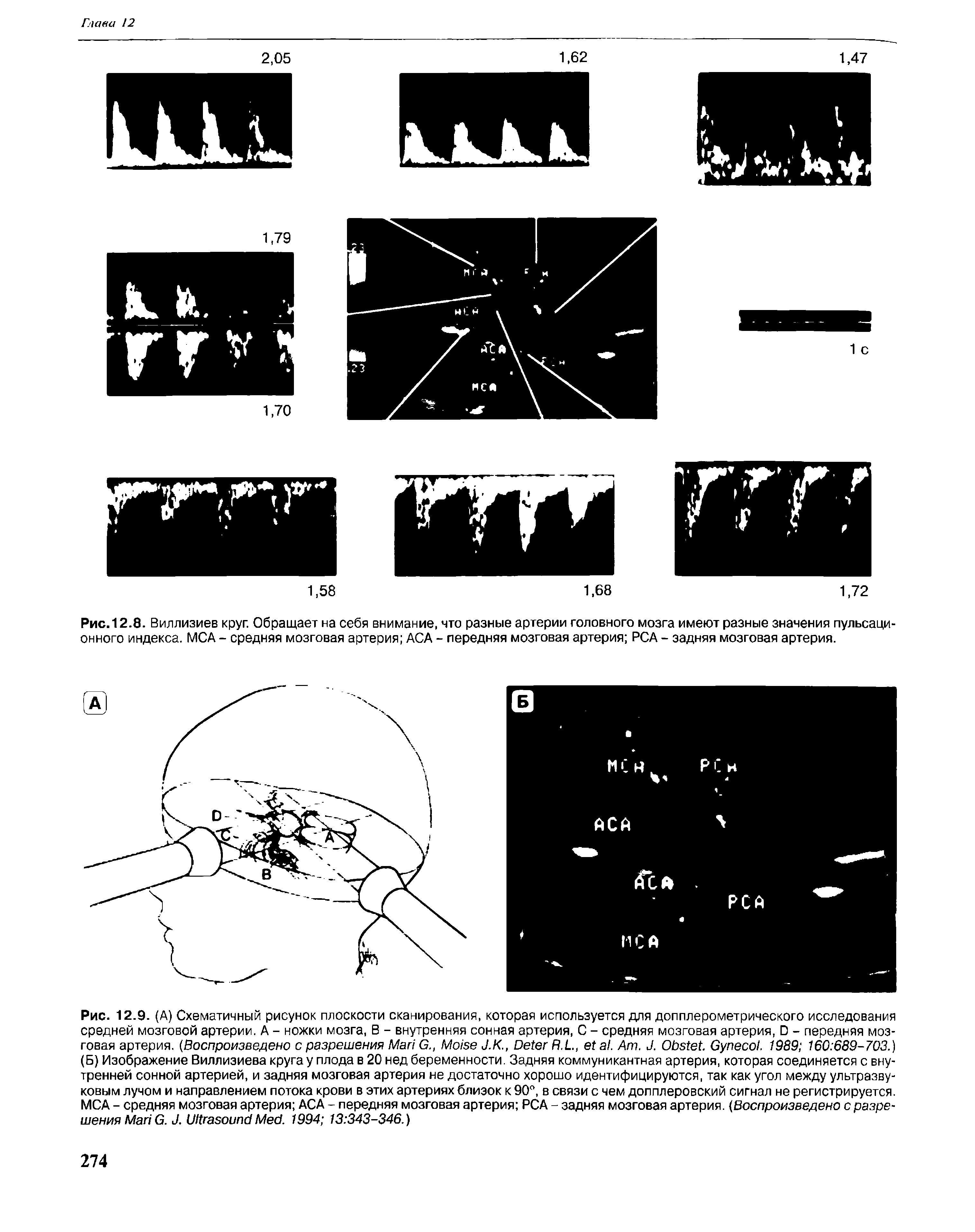 Рис. 12.8. Виллизиев круг. Обращает на себя внимание, что разные артерии головного мозга имеют разные значения пульсационного индекса. МСА - средняя мозговая артерия АСА - передняя мозговая артерия РСА - задняя мозговая артерия.