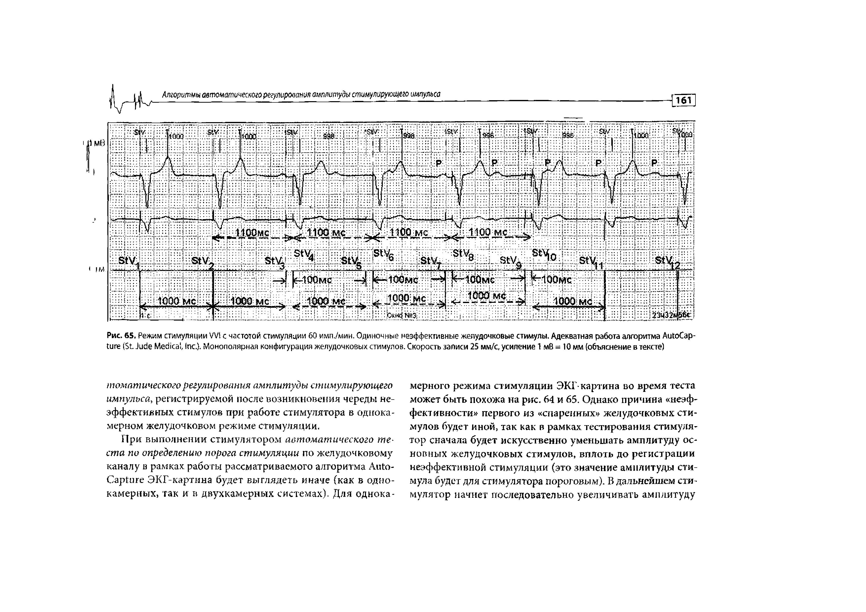 Рис. 65. Режим стимуляции VVI с частотой стимуляции 60 имп./мин. Одиночные неэффективные желудочковые стимулы. Адекватная работа алгоритма A C (S J M , I .). Монополярная конфигурация желудочковых стимулов. Скорость записи 25 мм/с, усиление 1 мВ = 10 мм (объяснение в тексте)...