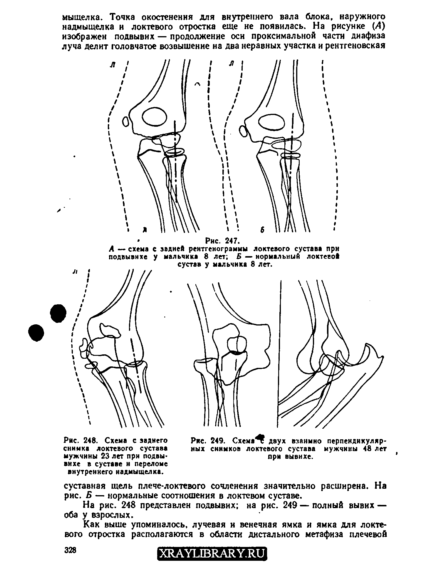 Рис. 248. Схема с заднего снимка локтевого сустава мужчины 23 лет при подвывихе в суставе н переломе внутреннего надмыщелка.