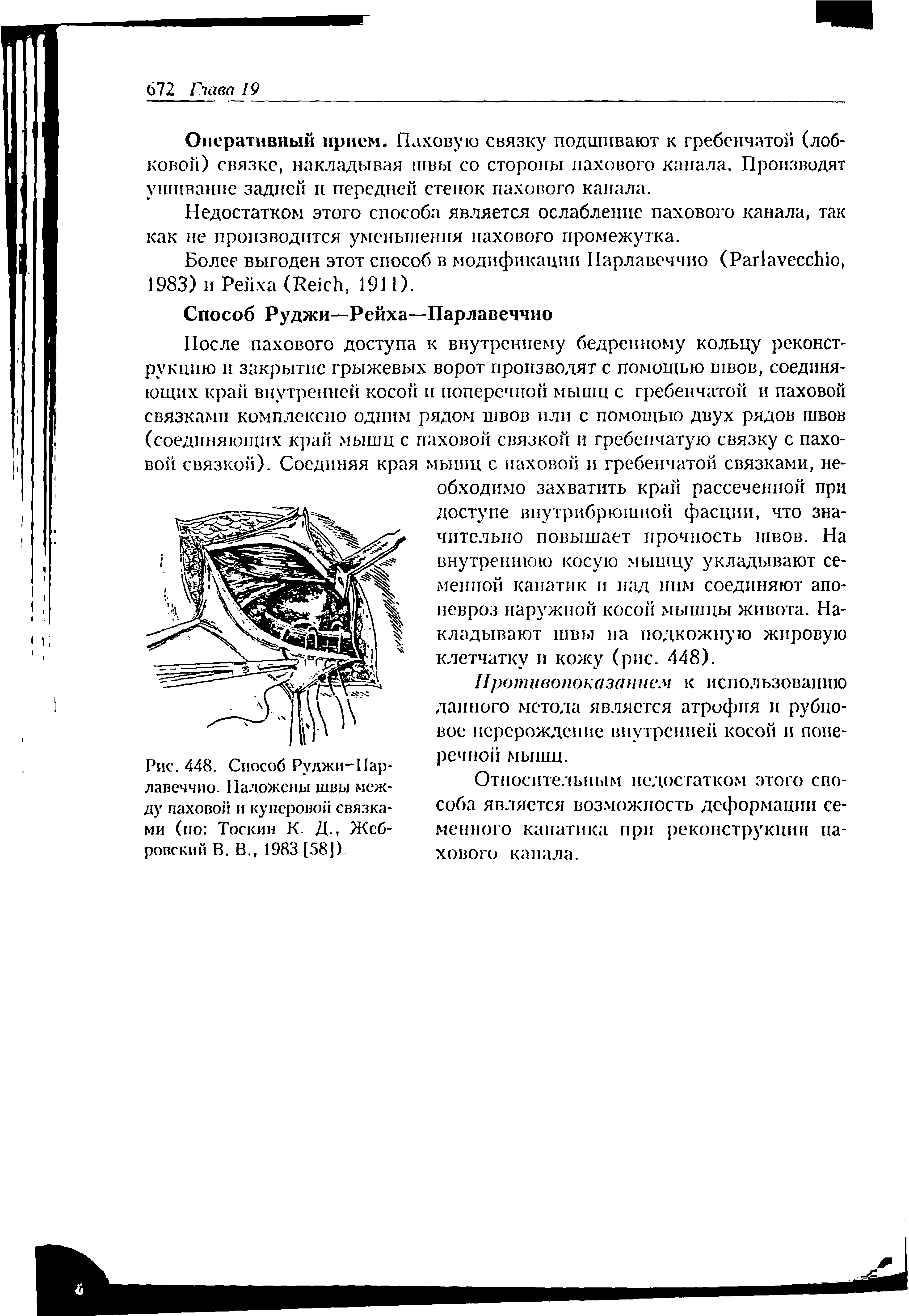 Рис. 448. Способ Руджи-Парлавеччио. Наложены швы между паховой и куперовой связками (по Тоски и К. Д., Жебровский В. В., 1983 [581)...