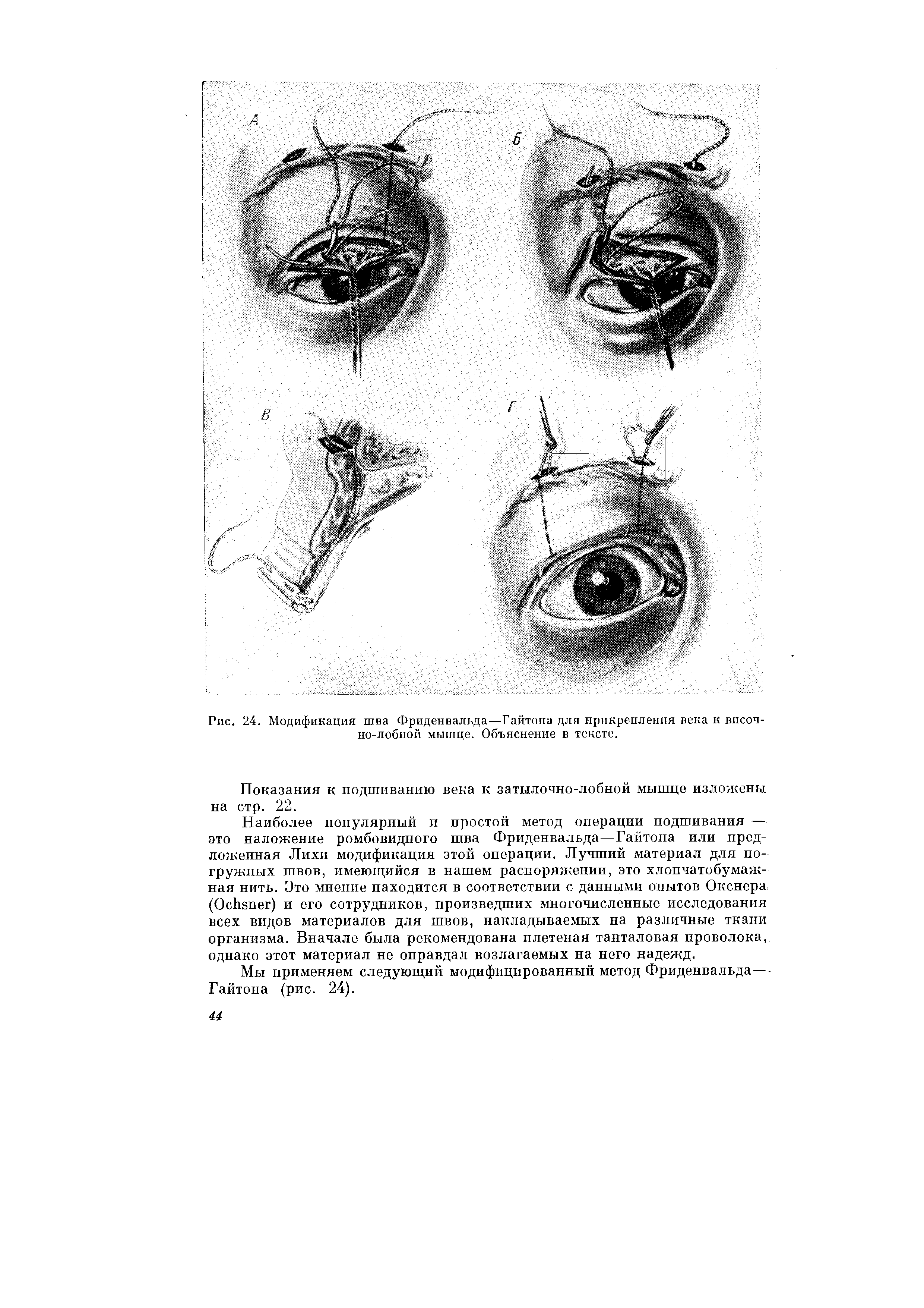 Рис. 24. Модификация шва Фриденвальда—Гайтона для прикрепления века к височно-лобной мышце. Объяснение в тексте.