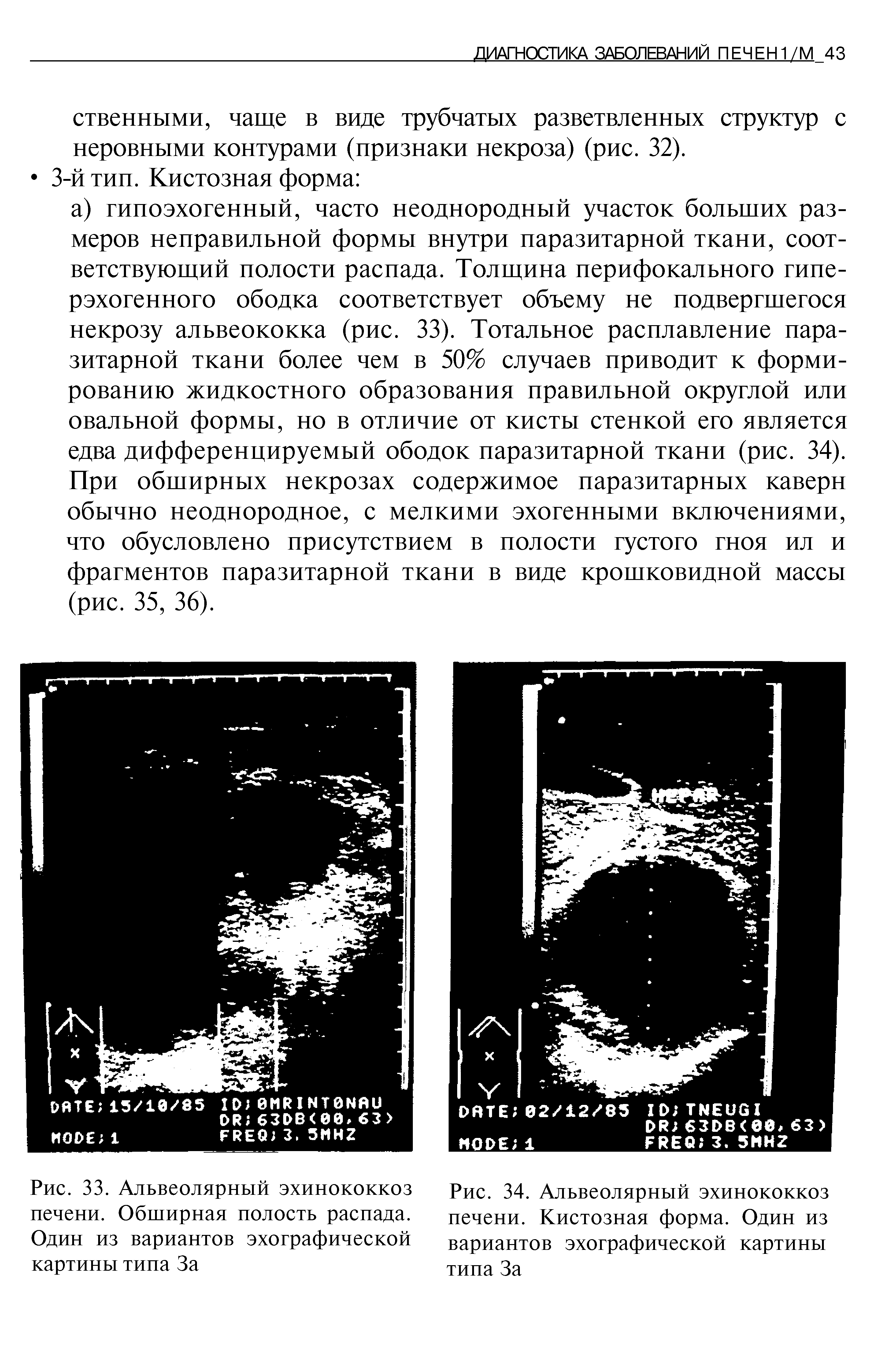 Рис. 34. Альвеолярный эхинококкоз печени. Кистозная форма. Один из вариантов эхографической картины типа За...