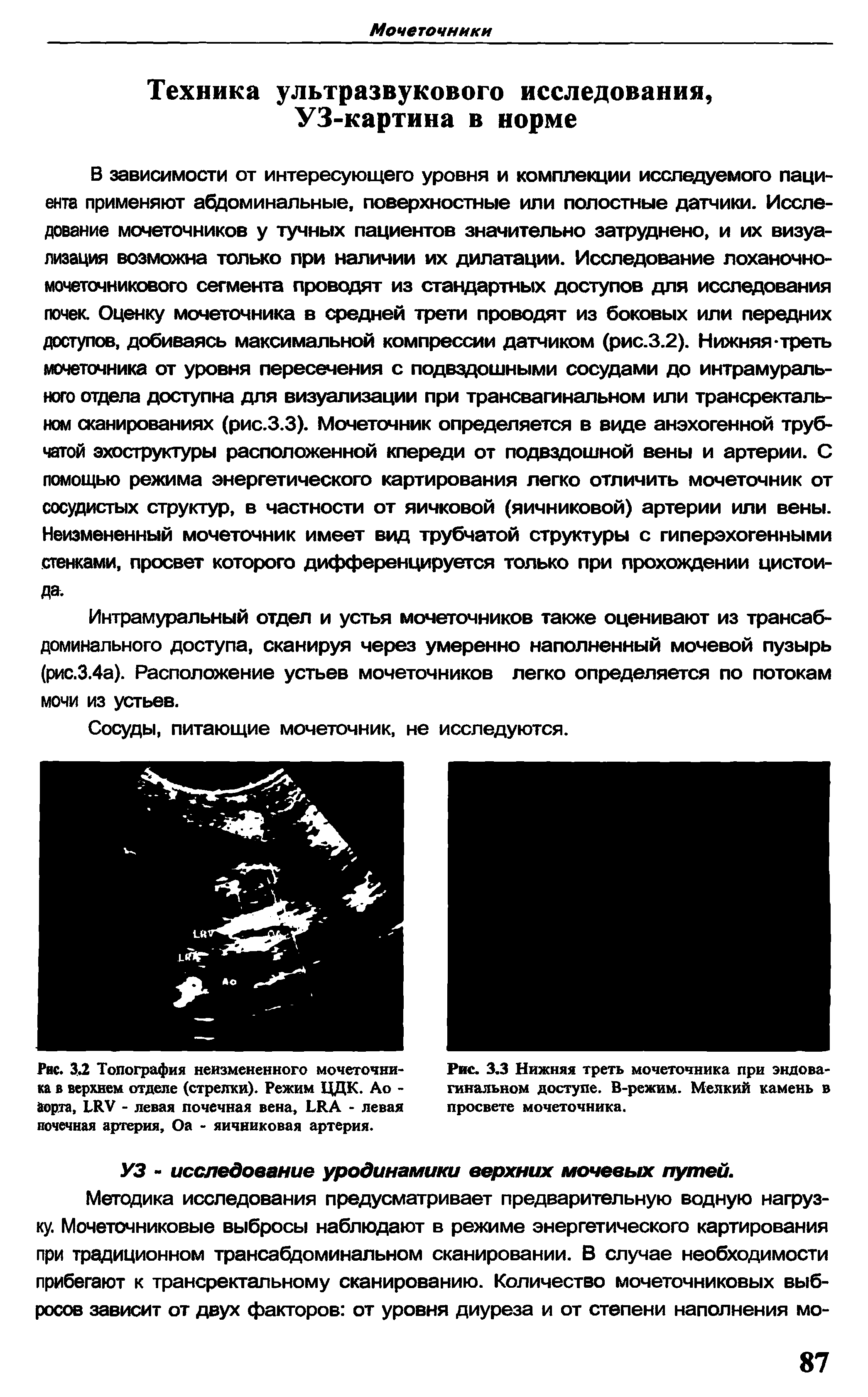 Рис. 3.2 Топография неизмененного мочеточника в верхнем отделе (стрелки). Режим ЦДК. Ао -Ворта, LRV - левая почечная вена, LRA - левая почечная артерия, Оа - яичниковая артерия.