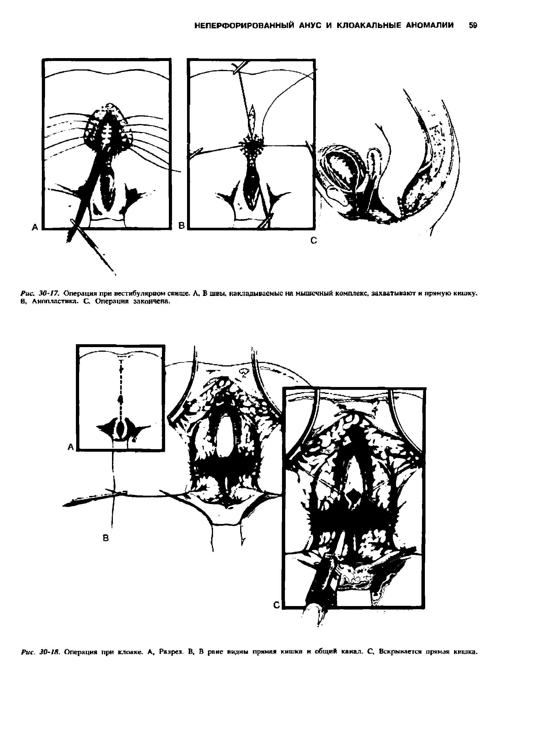 Рис. 30- Я. Операция при клоаке. А, Разрез. В, В райе видны прямая кишка и общий канал. С, Вскрывается прямая кишка.