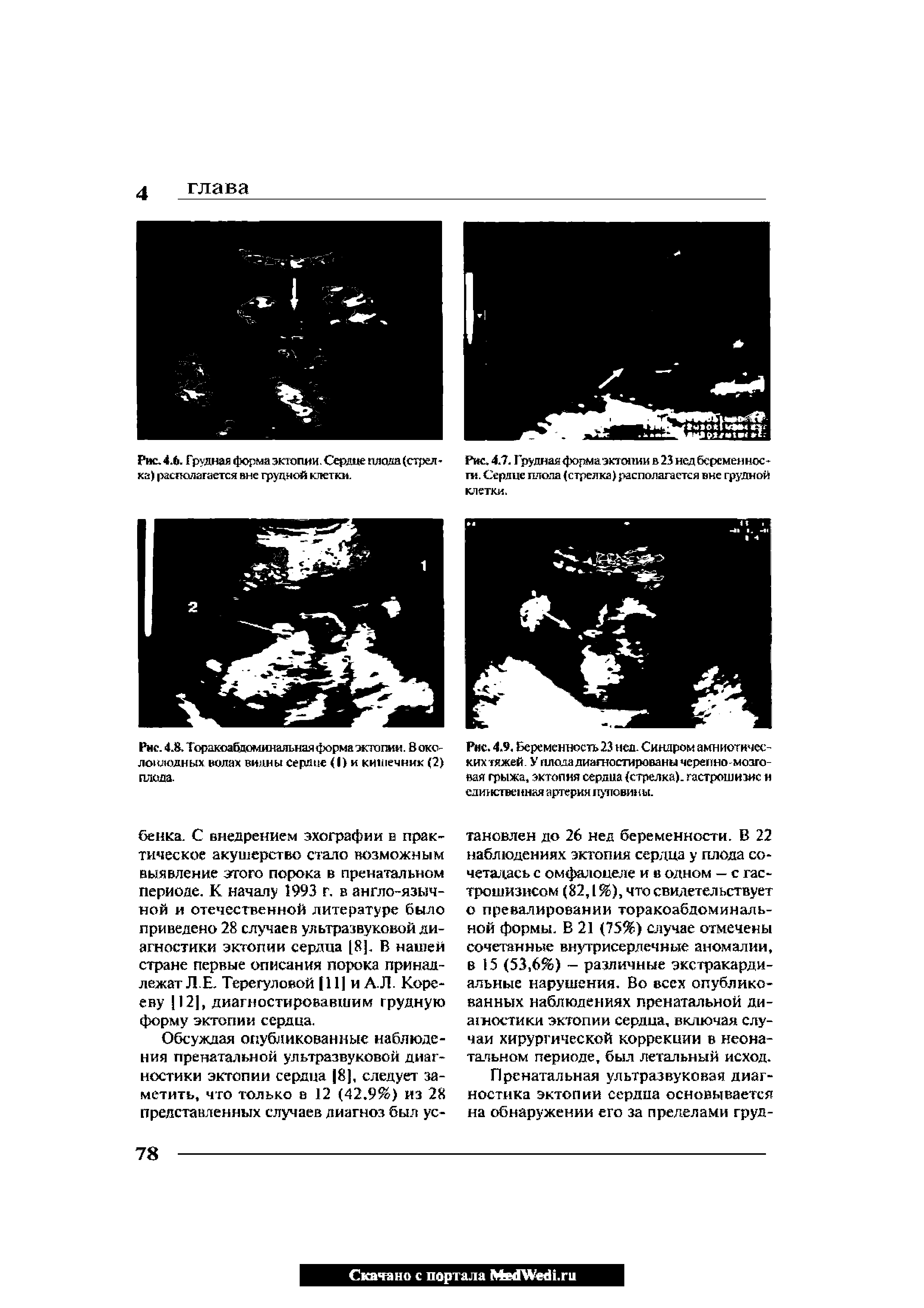 Рис. 4.8. Торакоабдоминальная форма эктопии. В око лотоюдных водах видны сердце (I) и кишечник (2) плода.