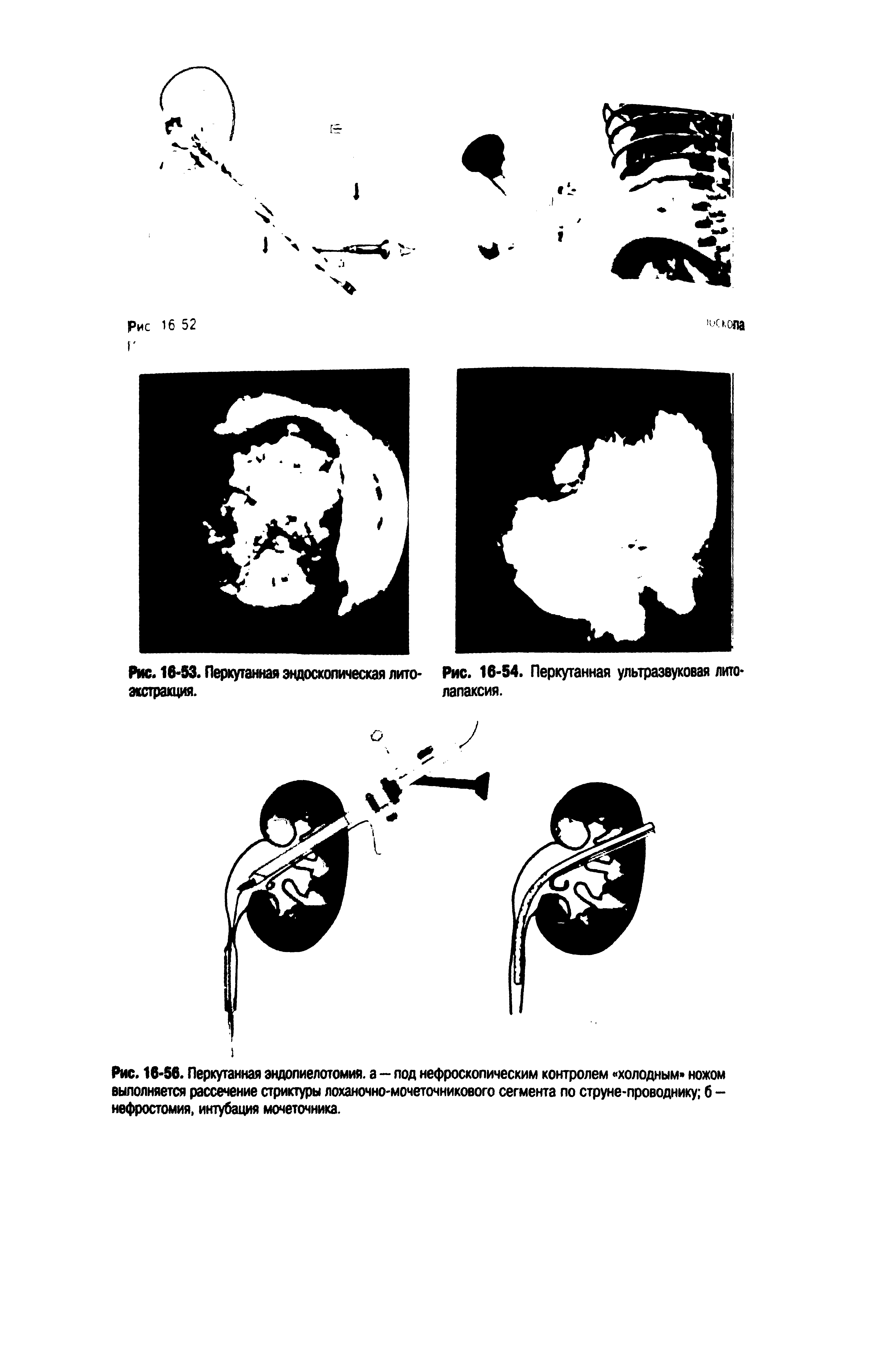 Рис. 16-56. Перкутанная эндопиелотомия. а — под нефроскопическим контролем холодным ножом выполняется рассечение стриктуры лоханочно-мочеточникового сегмента по струне-проводнику б -нефростомия, интубация мочеточника.
