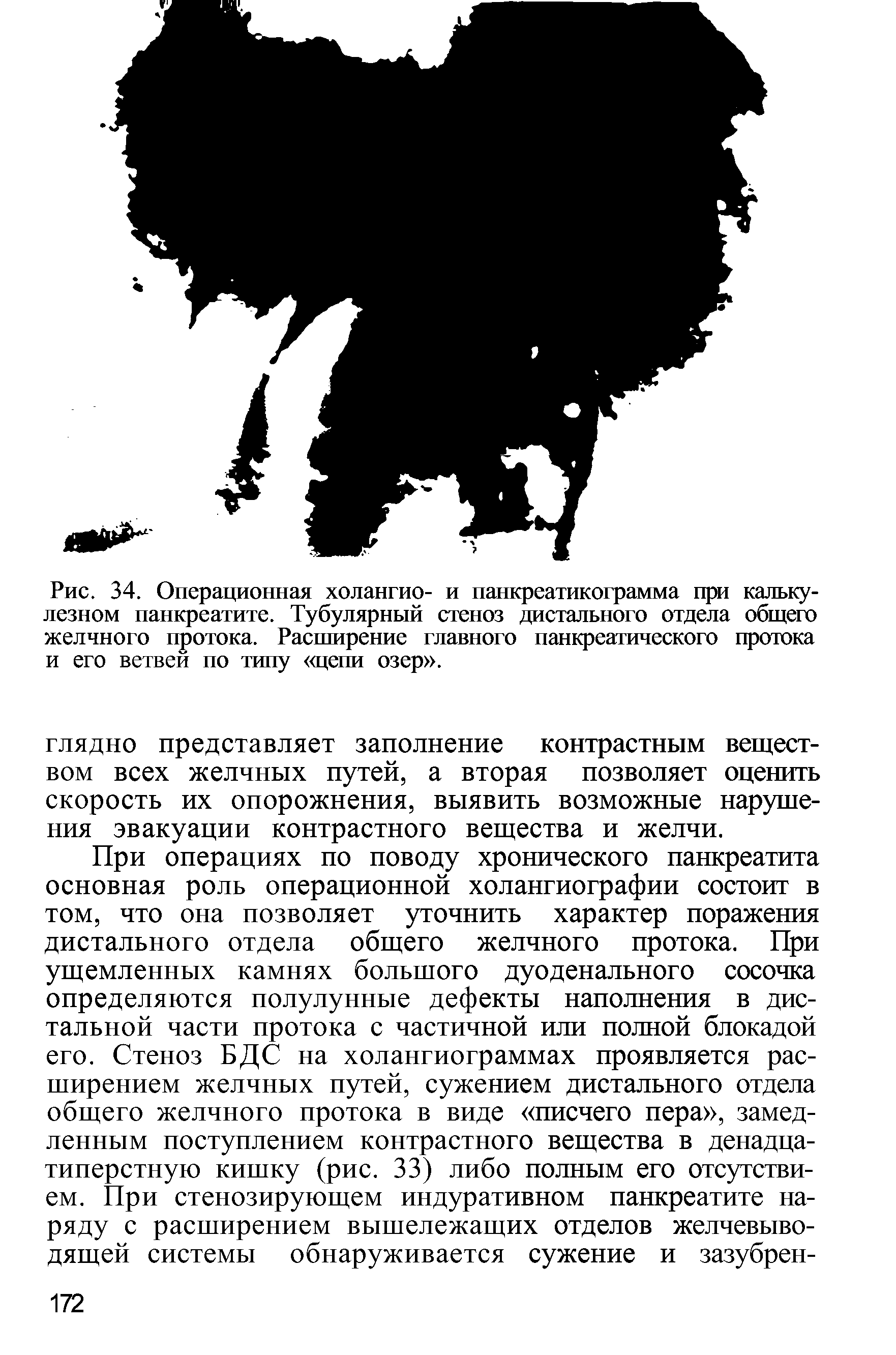 Рис. 34. Операционная холангио- и панкреатикограмма при кальку-лезном панкреатите. Тубулярный стеноз дистального отдела общего желчного протока. Расширение главного панкреатического протока и его ветвей по типу цепи озер .